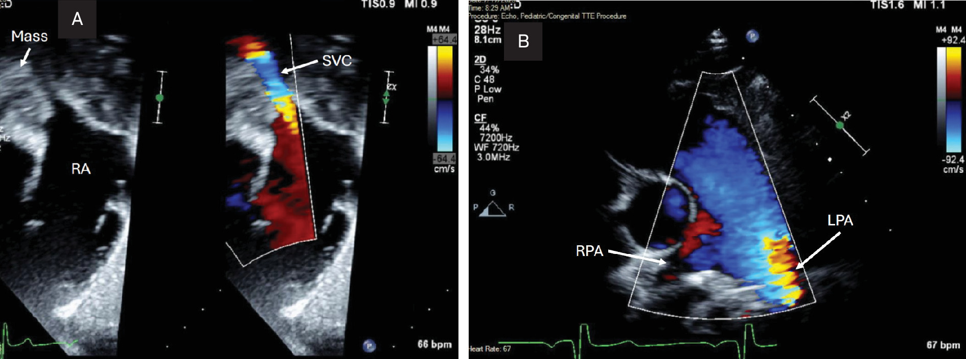 (A) Transthoracic echocardiogram color compare subcostal sagittal view. There is an anterior mass causing external compression of the superior vena cava (SVC). There is an increased flow gradient (8 mm Hg, normal 1 - 2 mm Hg) across the SVC in the area of external compression. RA, right atrium. (B) Transthoracic echocardiogram color Doppler parasternal short -axis view. There is minimal color flow to the right pulmonary artery (RPA) compared with the left pulmonary artery (LPA), supporting severe stenosis of the right pulmonary artery.