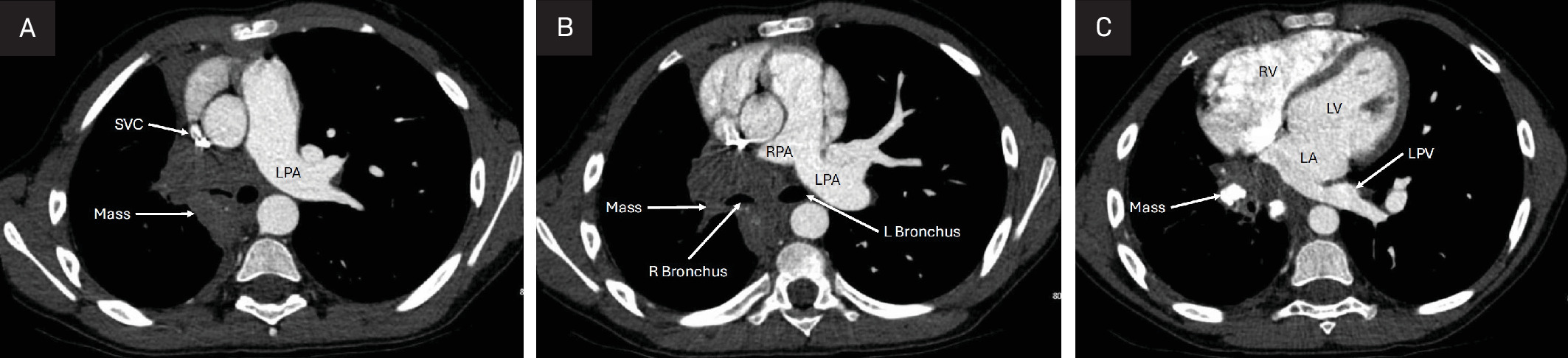 (A) Chest CTA axial plane. There is a large partially calcified conglomerate right hilar mass causing severe external compression of the superior vena cava (SVC) and moderate external compression of the right mainstem bronchus. LPA, left pulmonary artery. (B) Chest CTA axial plane. There is a large partially calcified conglomerate right hilar mass causing complete occlusion of the right pulmonary artery (RPA) just prior to the first - order branches. There is moderate external compression of the right mainstem bronchus (R Bronchus). L Bronchus, left mainstem bronchus; LPA, left pulmonary artery. (C) Chest CTA axial plane. There is a large partially calcified conglomerate right hilar mass causing complete occlusion of the right pulmonary veins. LA , left atrium; LPV, left pulmonary vein; LV, left ventricle; RV, right ventricle.