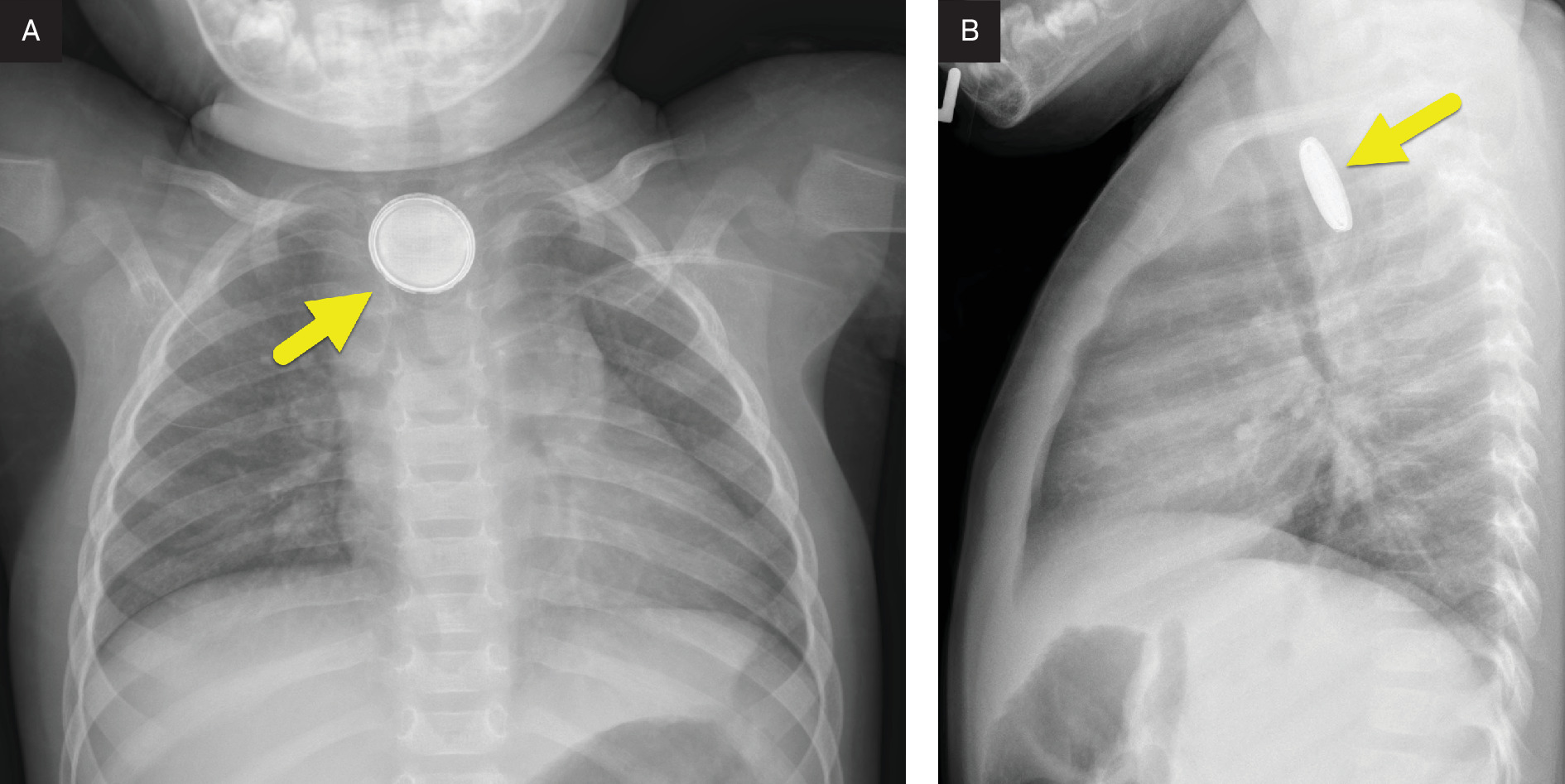 (A) Frontal and (B) lateral chest radiographs showing a button battery (arrow) lodged within the proximal esophagus at the level of the aortic arch. The battery demonstrates an irregular margin, suggesting prolonged impaction and early degradation.