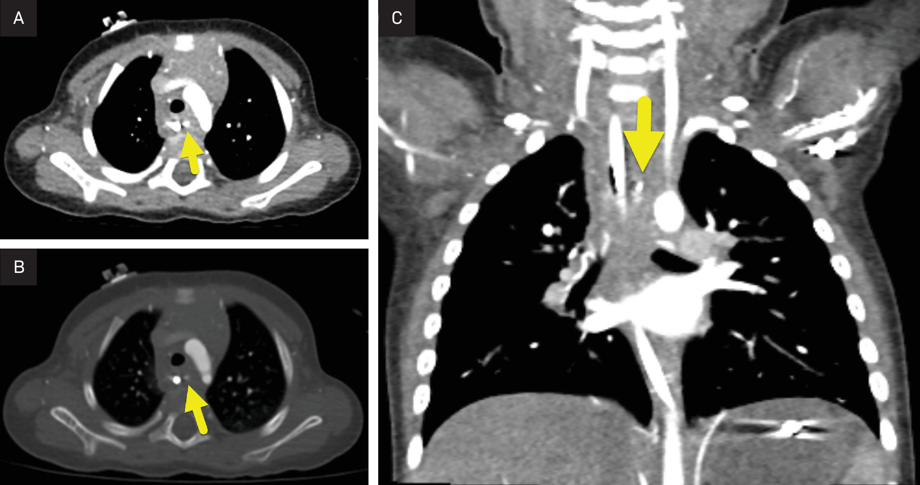 Axial CT images of the chest in (A) soft tissue and (B) bone windows, along with (C) coronal CT reconstruction, showing residual battery fragments (arrow) at the prior site of impaction. No adjacent aortic wall irregularity is identified.