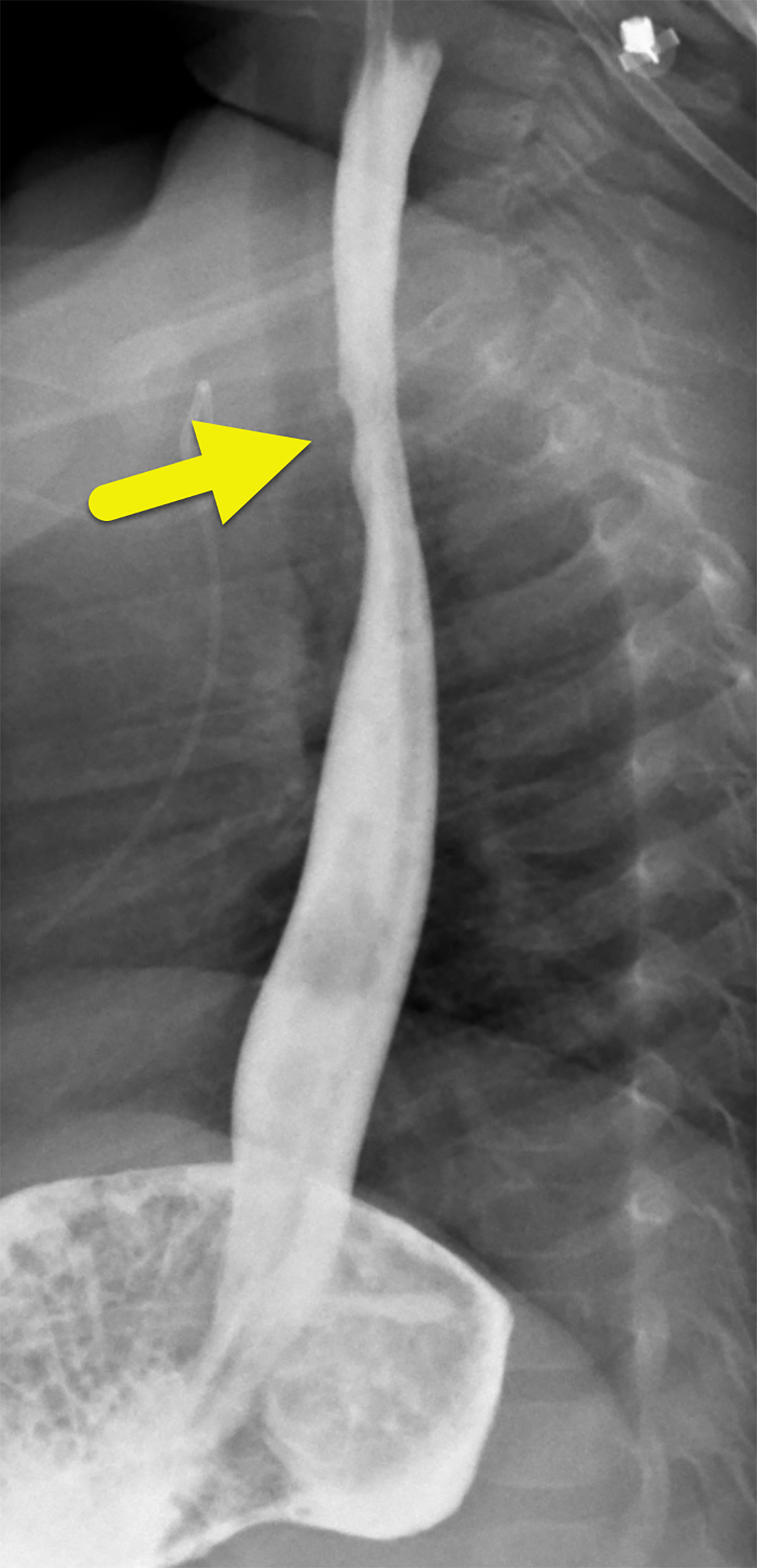 Lateral image from an upper gastrointestinal examination demonstrating focal irregularity (arrow) of the proximal esophagus at the site of prior battery impaction.