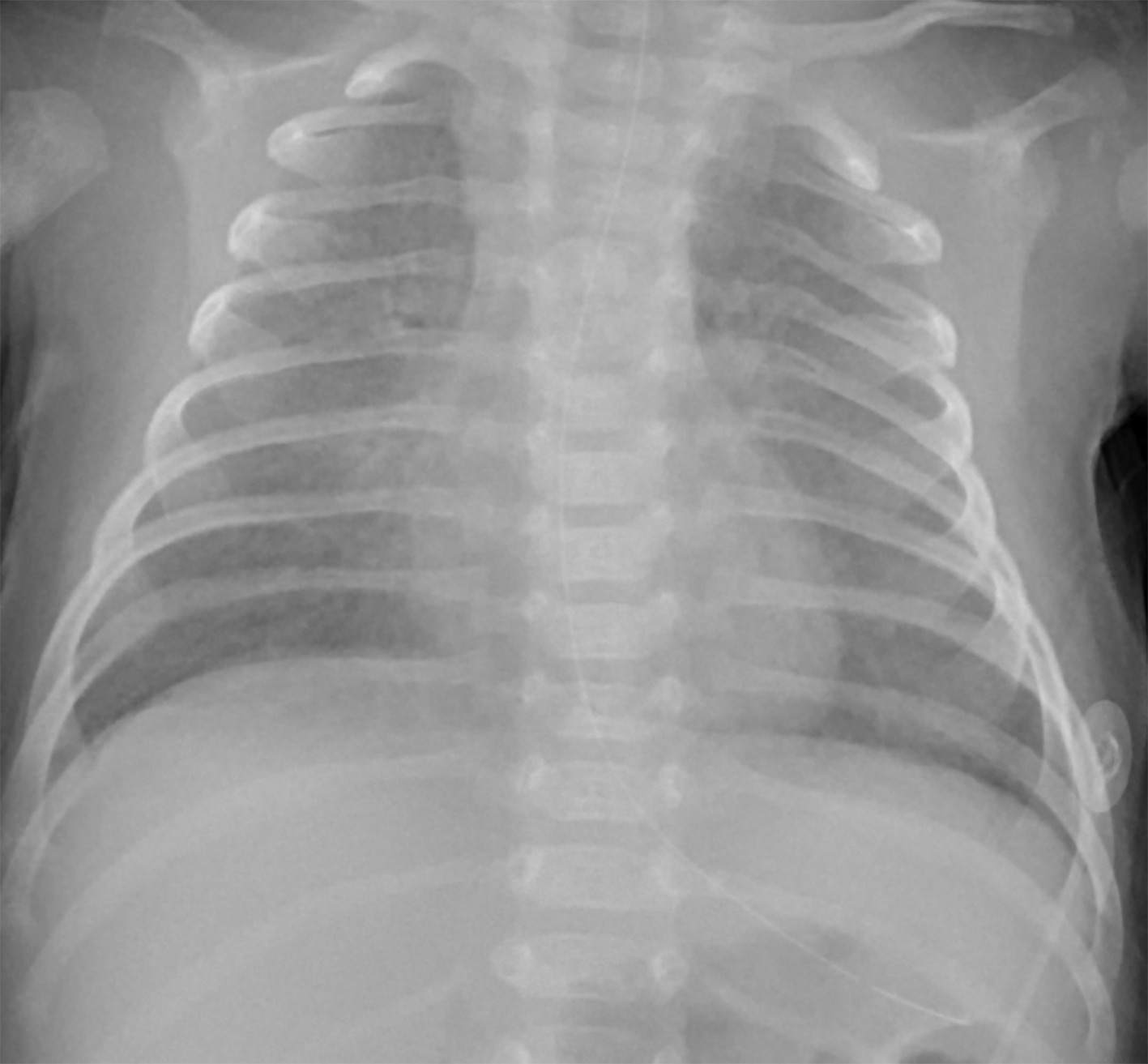 Frontal chest radiograph showing diffuse ground-glass opacity.