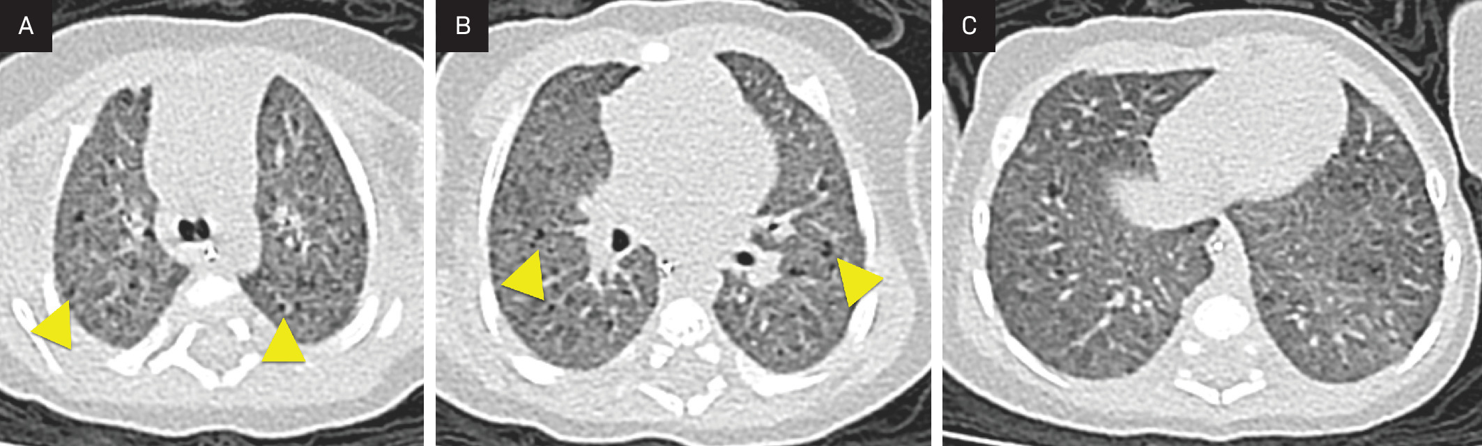 Axial images from chest CT obtained at the level of the (A) carina, (B) main pulmonary artery, and (C) lung bases showing diffuse ground-glass opacity and small cystic spaces (arrowheads) in the posterior lungs.