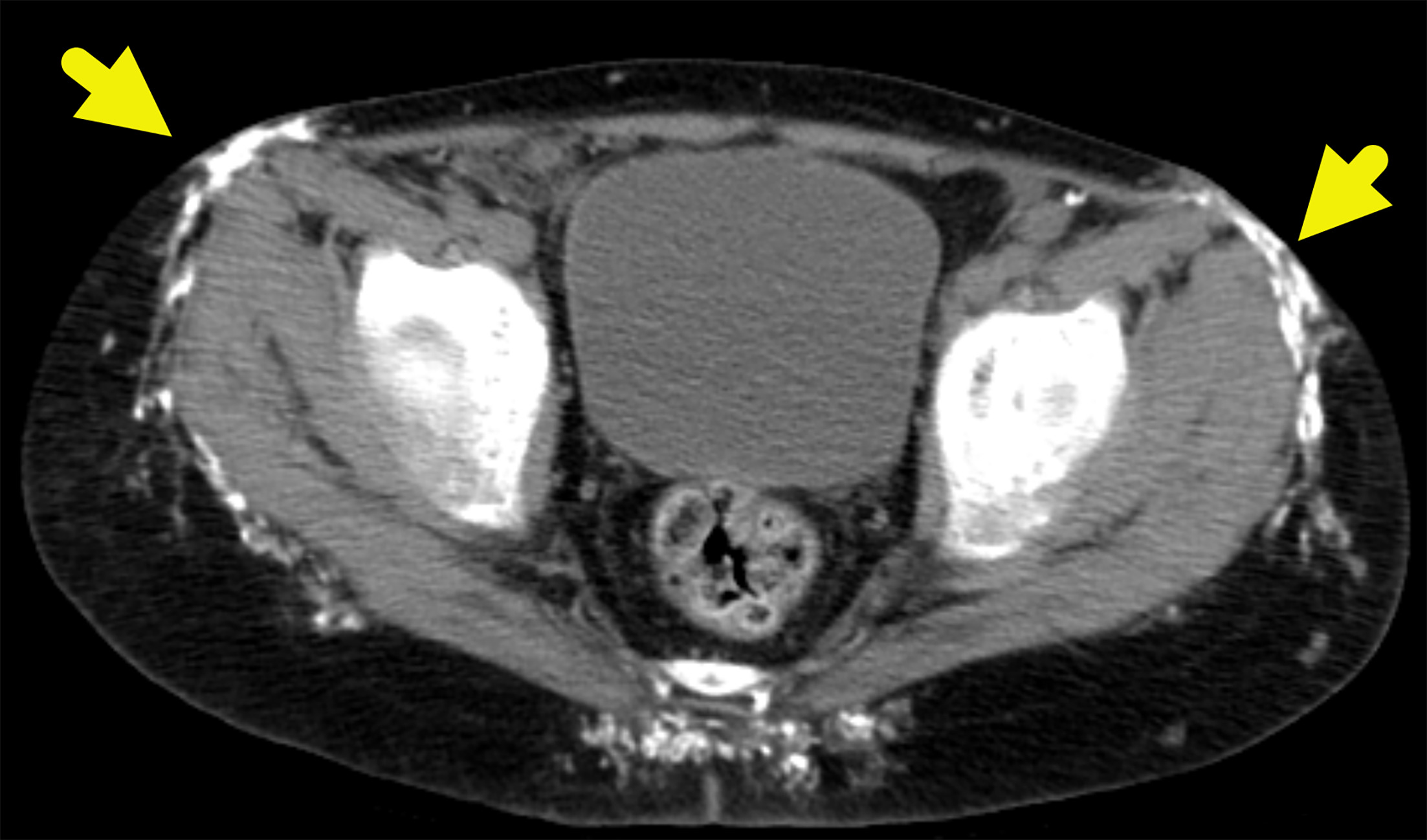 Axial CT image of the pelvis showing dystrophic calcification (arrows) at the subcutaneous fat-muscle interface.
