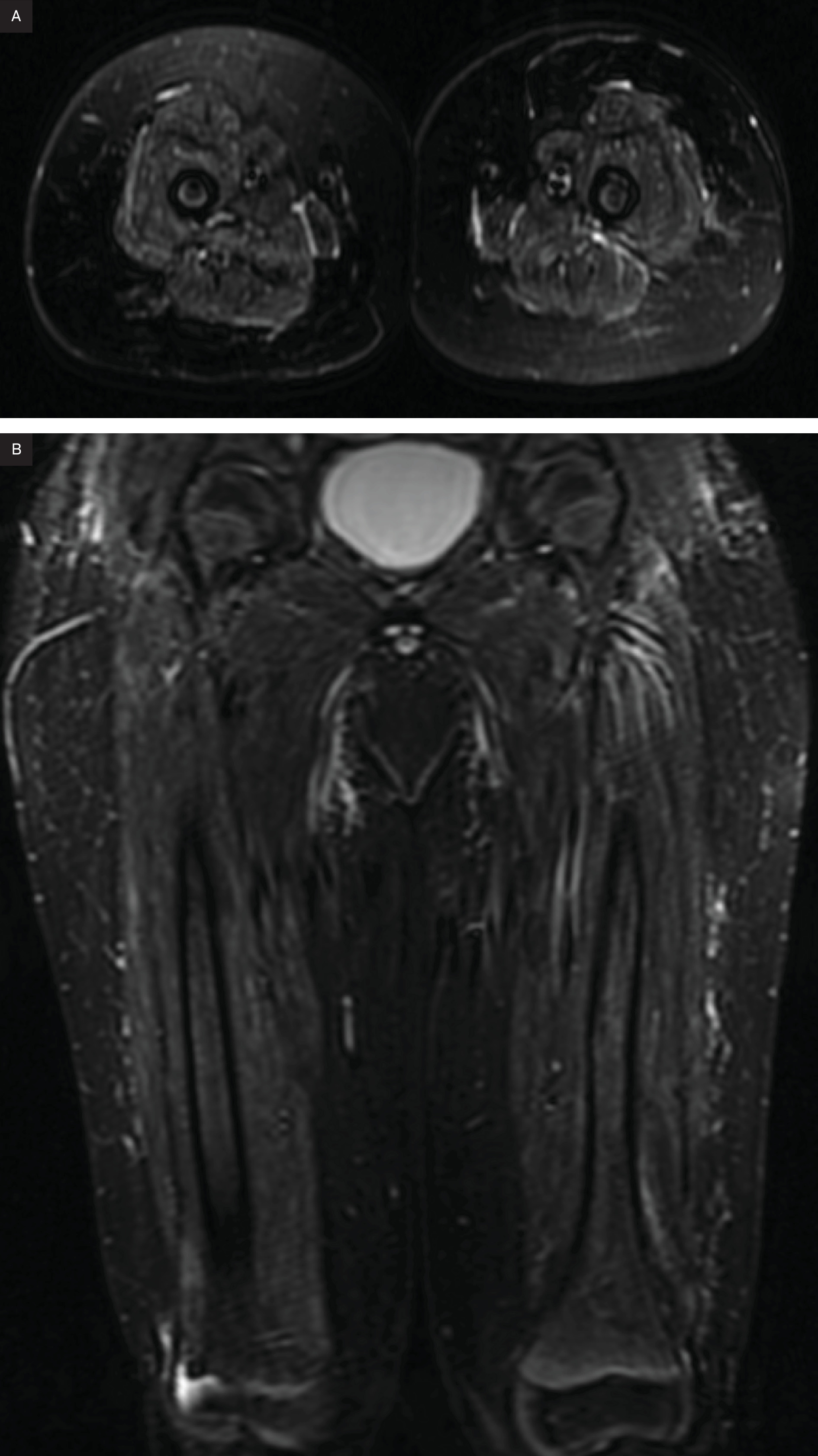 (A) Axial and (B) coronal short tau inversion recovery MR images of the lower extremities demonstrating mild increased T2 signal within the thigh musculature, most prominently at the myofascial junctions.