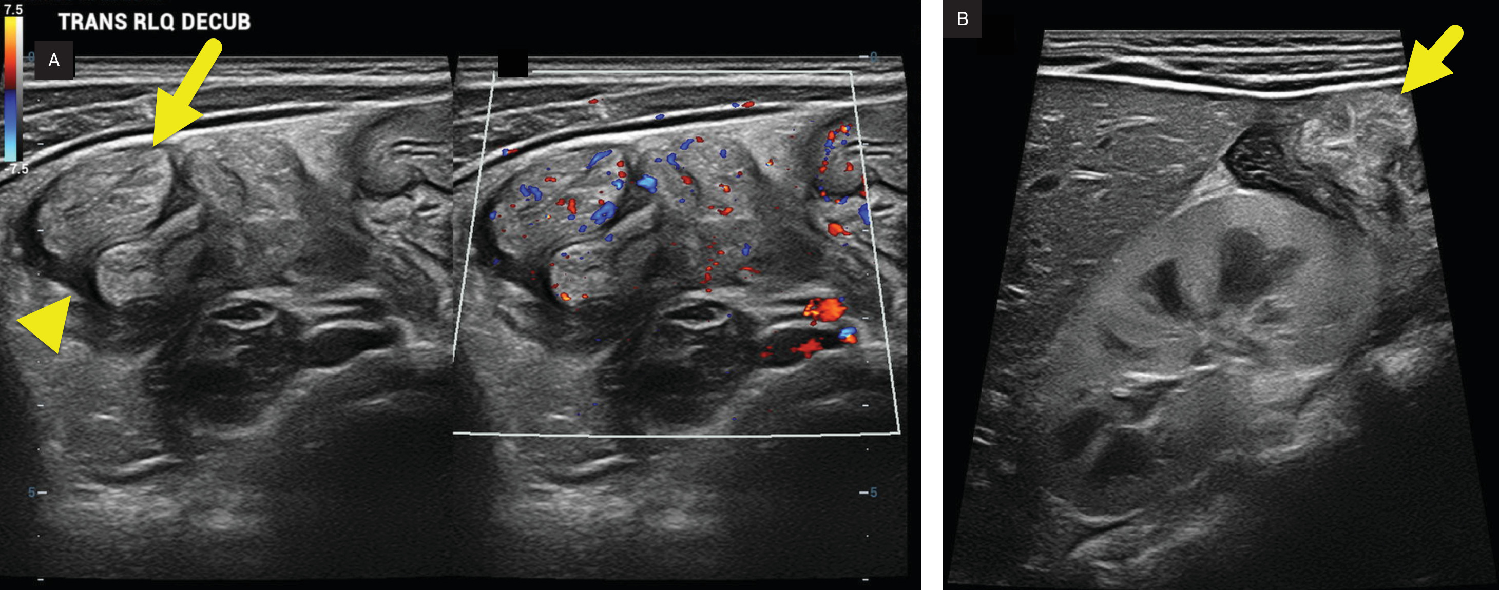 (A) Transverse color Doppler US image of the bowel in the right lower quadrant showing diffuse bowel wall thickening (arrow), bowel hyperemia, and mild ascites (arrowhead). (B) Longitudinal image of the right kidney showing it to be enlarged and diffusely echogenic.