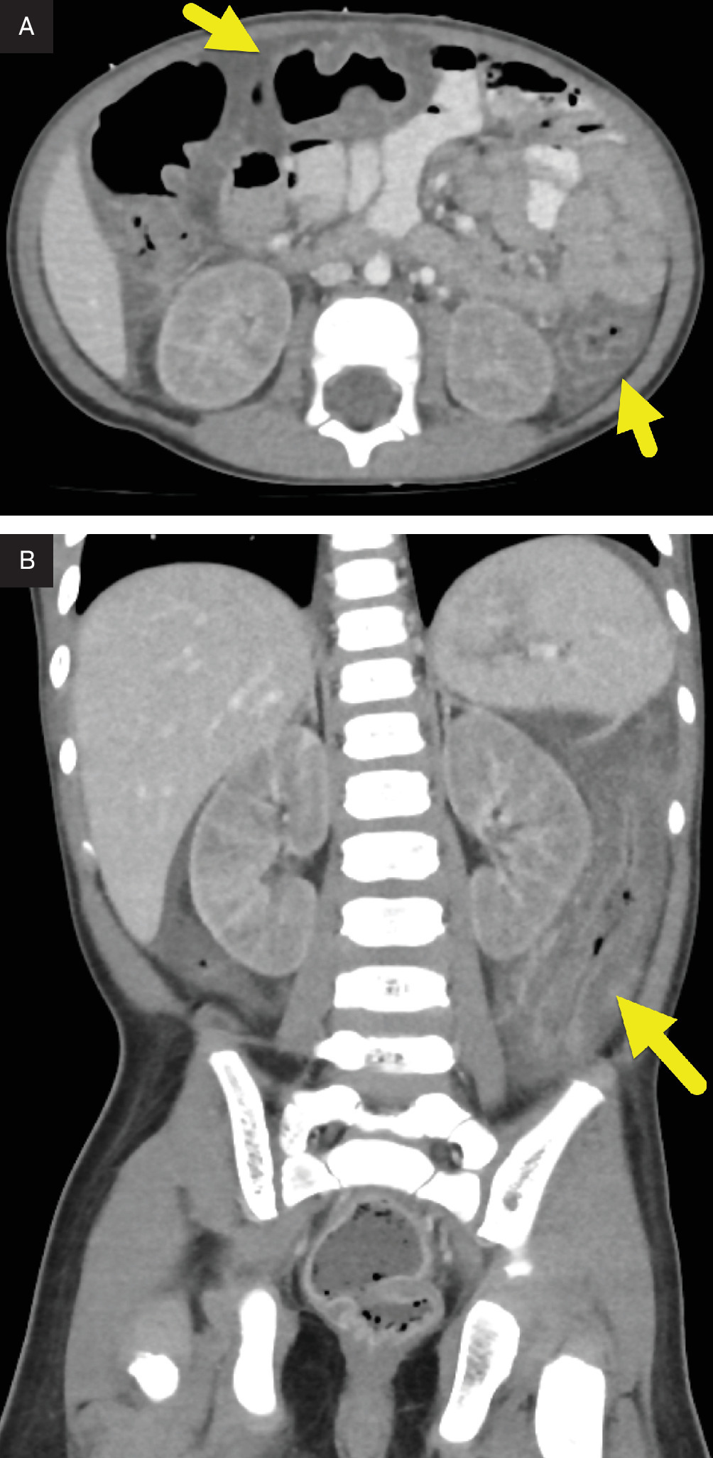 (A) Axial and (B) coronal CT images of the abdomen showing diffuse bowel wall thickening (arrows), mild ascites (arrowhead), and abnormal enhancement of the diffusely enlarged kidneys.