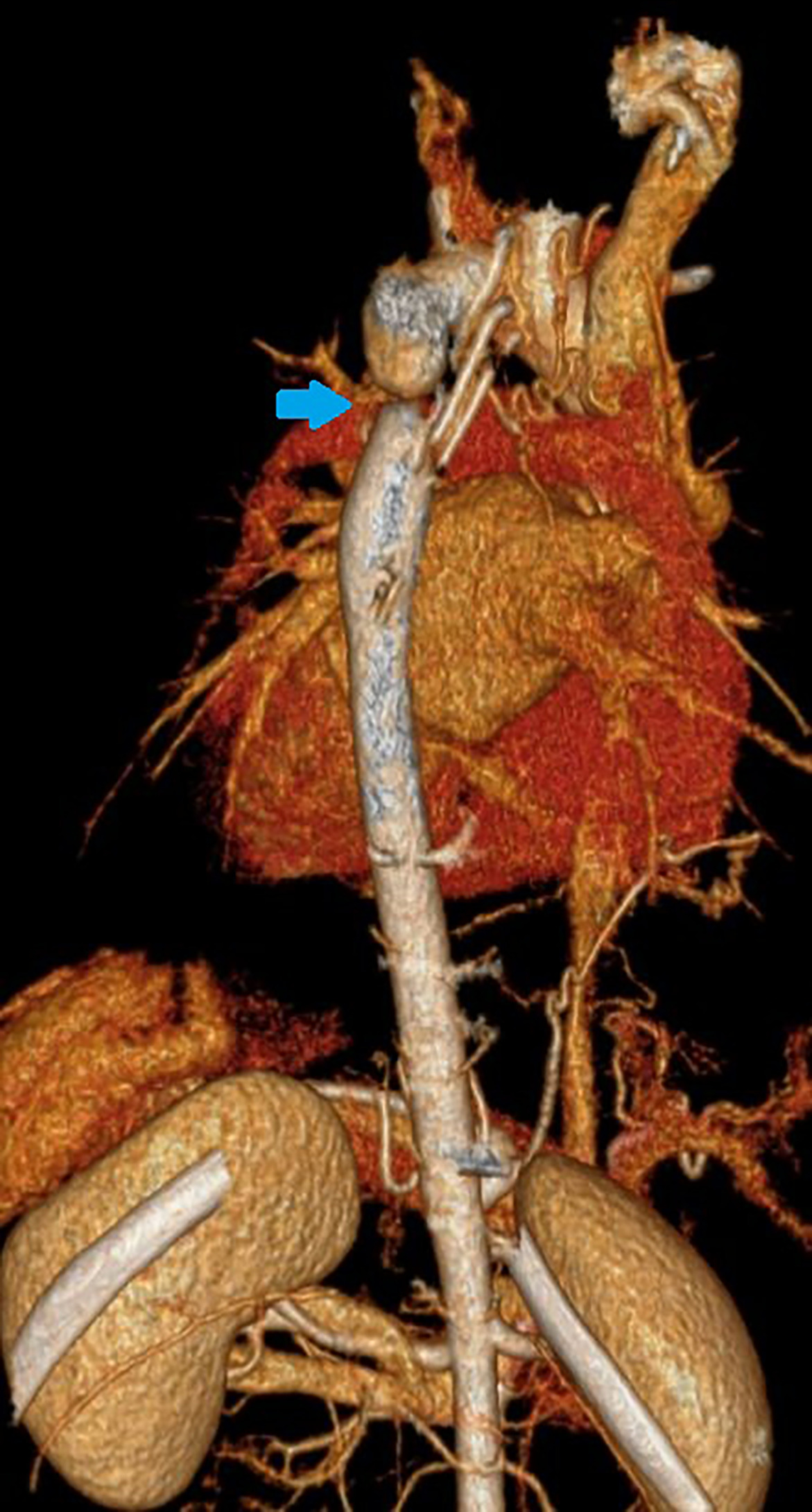 3D CTA of the chest with a posterior view demonstrating a severe coarctation/interruption of the aorta (blue arrow).