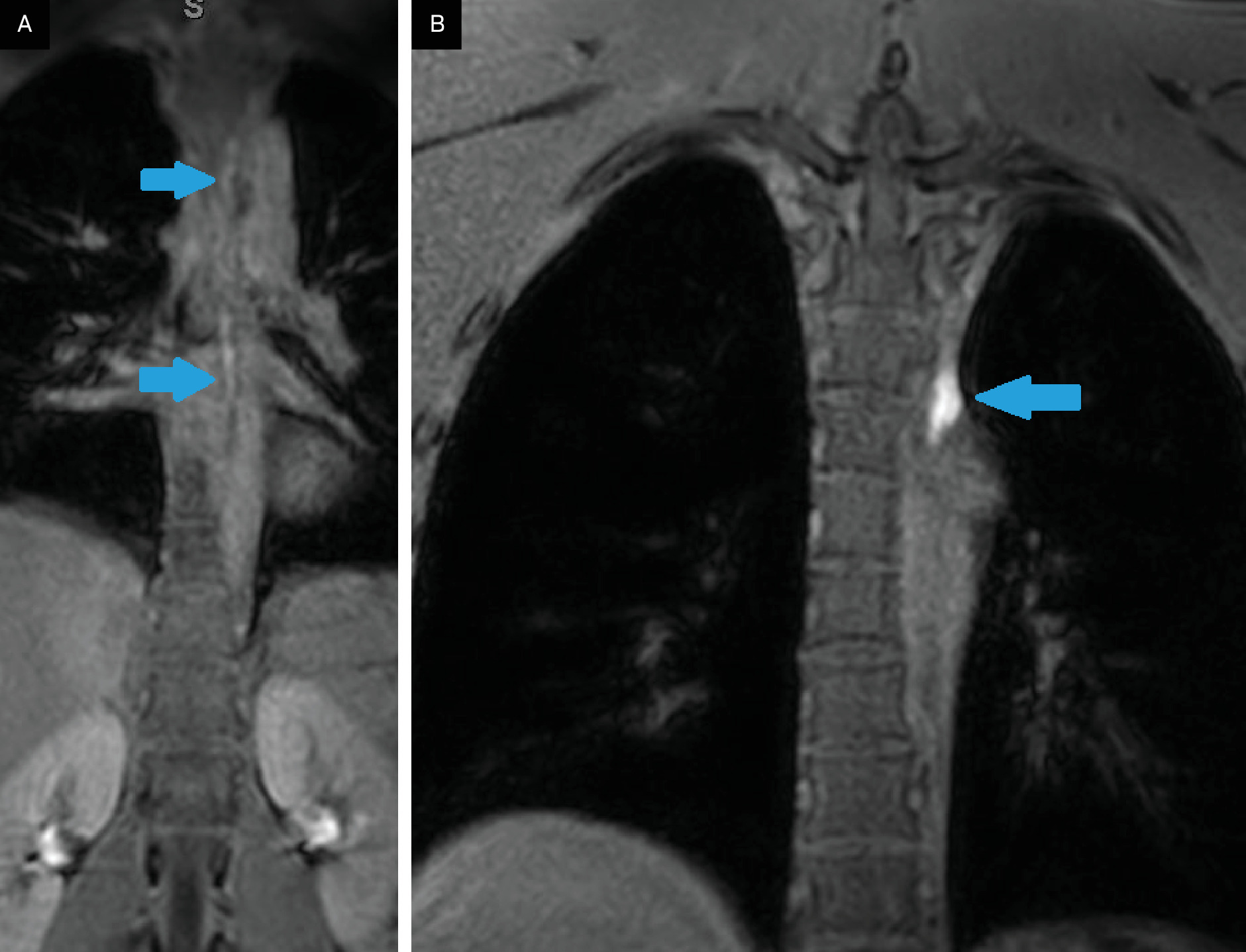 (A, B) Dynamic contrast-enhanced MR lymphangiogram demonstrating visualization of the thoracic duct (TD) at 33 minutes (blue arrows, A) and accumulation of contrast near the TD at the T3 level (blue arrow, B).