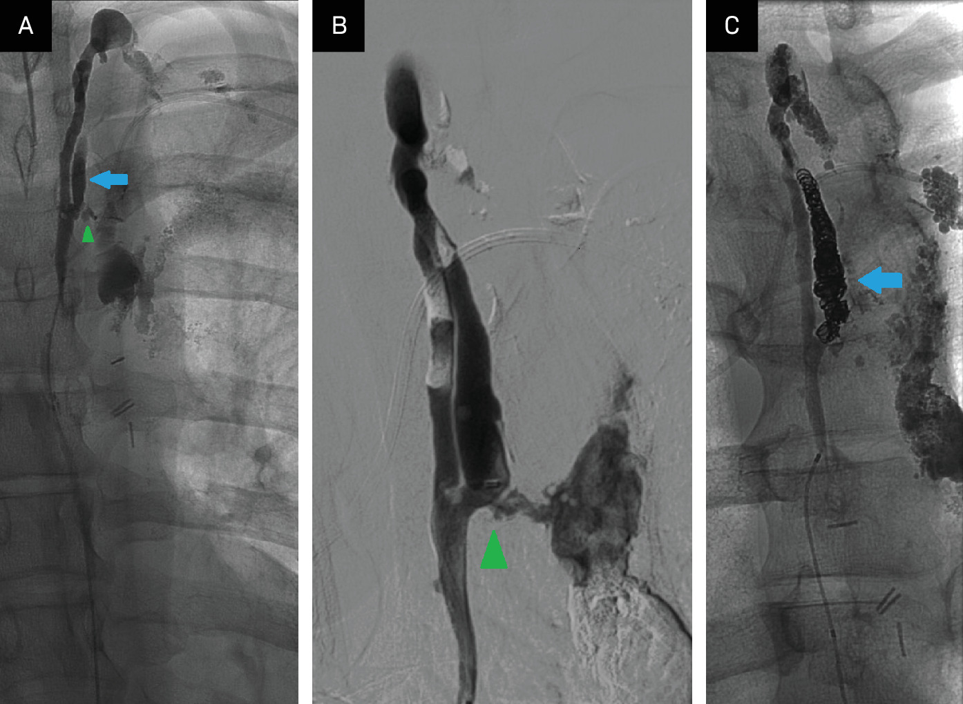 (A-C) Transabdominal thoracic duct access with contrast injection demonstrating duplication of the thoracic duct (TD) in (A) (blue arrow), with leakage of contrast from the left-sided duplication (green arrowhead). (B) The microcatheter tip is in the inferior-most aspect of the left-sided TD duplication, and there is contrast exiting the caudad aspect of the duplicated TD (green arrowhead). Successful coil embolization of the leaking duplicated TD with cessation of contrast leak (blue arrow) can be seen.