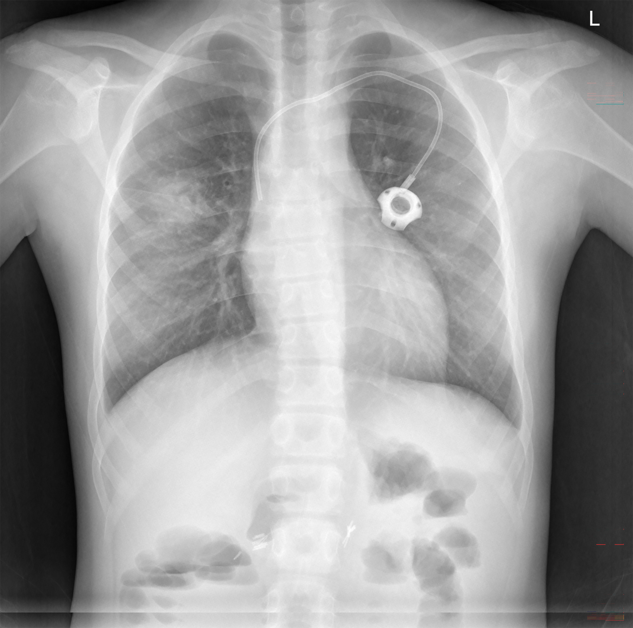 A frontal chest radiograph demonstrating a rounded area of airspace opacification with ill-defined margins and lucencies in the upper aspect of the consolidation (arrows).