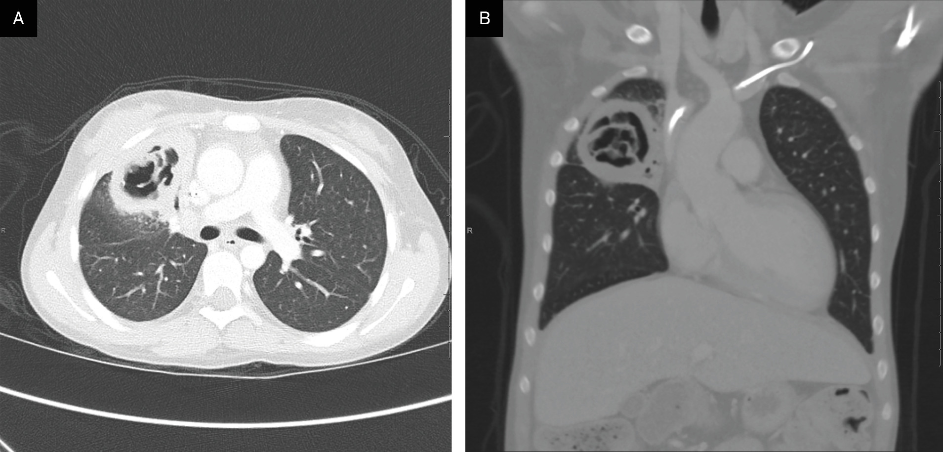 (A) Axial and (B) coronal images from a chest CT with interval coalescence of the small cavities into a large cavity with an associated fungus ball (arrowheads) within.