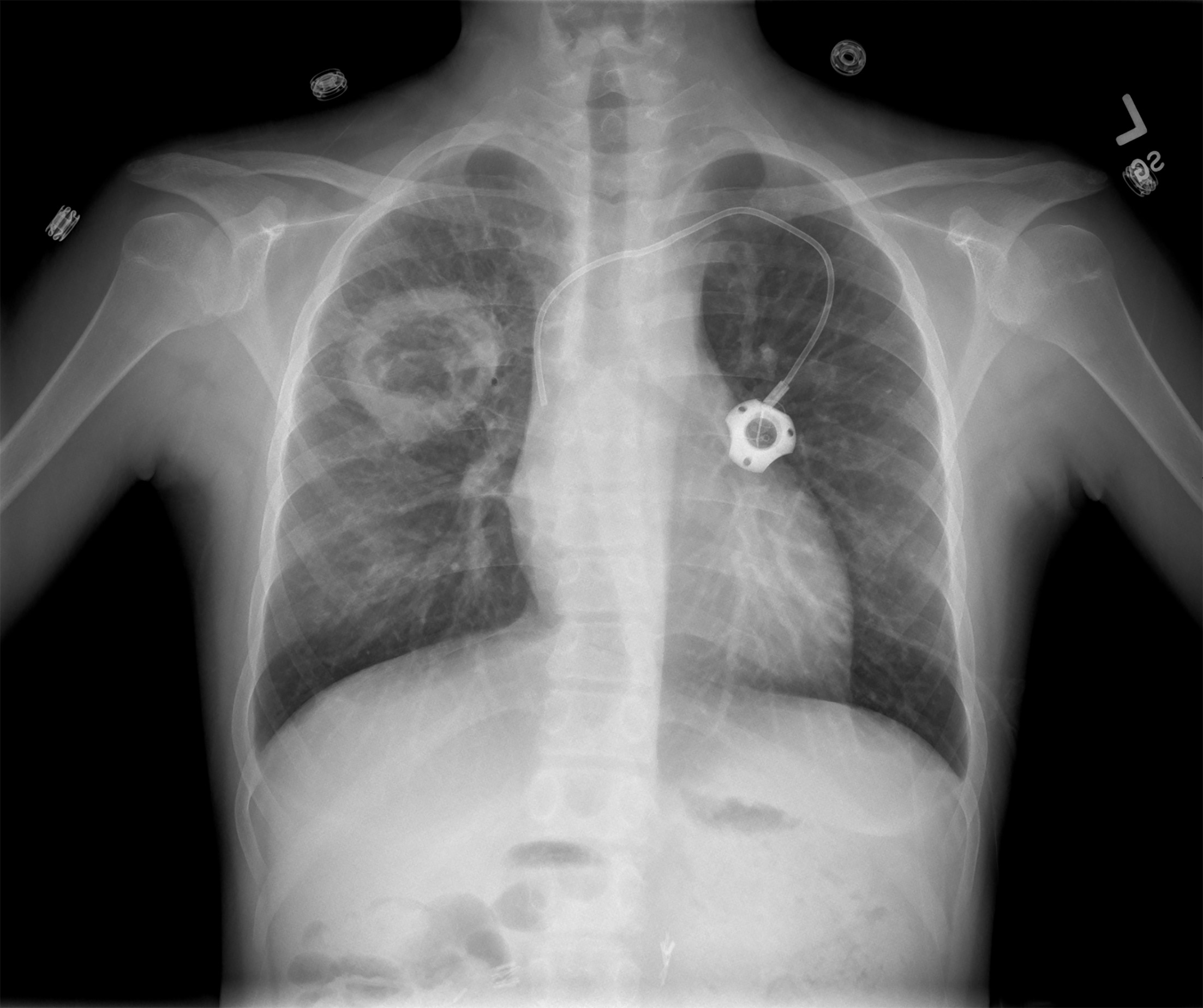 Follow-up frontal chest radiograph showing the sharply defined, round lesion with a large, central cavity.