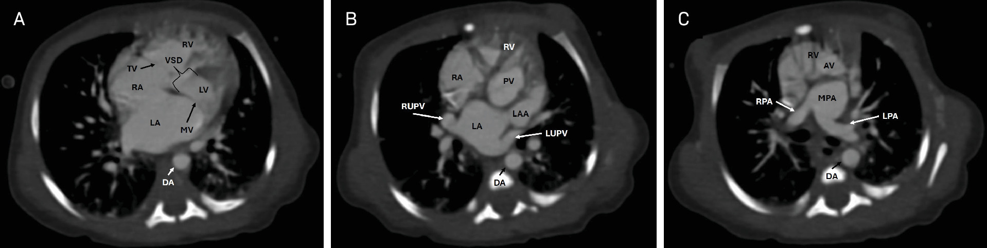 (A) Chest CTA with contrast in an axial plane at the ventricular mass. There is a large VSD in a patient with double outlet right ventricle (DORV). DA, descending aorta; LA, left atrium; LV, left ventricle; MV, mitral valve; RA, right atrium; RV, right ventricle; TV, tricuspid valve; VSD, ventricular septal defect. (B) Chest CTA with contrast in an axial plane at the pulmonary valve. The VSD is subpulmonic. DA, descending aorta; LA, left atrium; LAA, left atrial appendage; LUPV, left upper pulmonary vein; PV, pulmonary valve; RA, right atrium; RV, right ventricle; RUPV, right upper pulmonary vein. (C) Chest CTA with contrast in an axial plane at the aortic valve. The aortic valve arises from the right ventricle consistent with DORV. The main pulmonary artery is posterior to the aortic valve. AV, aortic valve; DA, descending aorta; LPA, left pulmonary artery; MPA, main pulmonary artery; RPA, right pulmonary artery; RV, right ventricle; RUPV, right upper pulmonary vein.