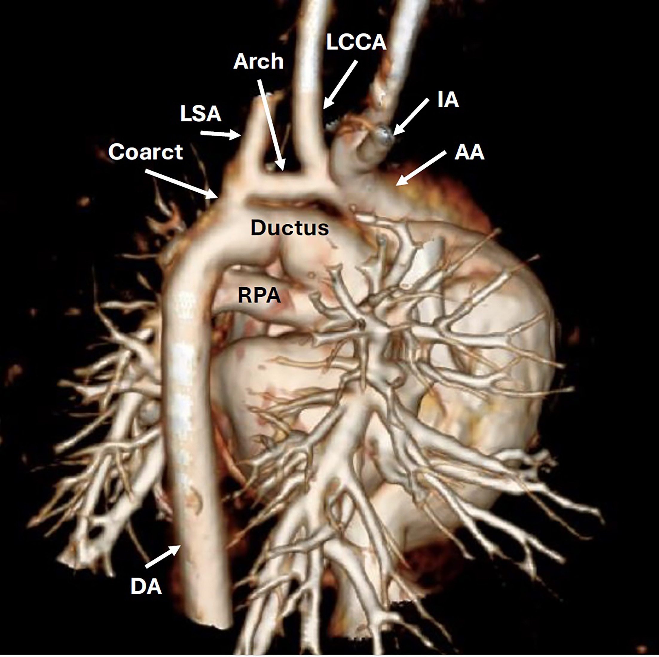 3D chest CTA with contrast in a sagittal projection. The aorta is superior to the main pulmonary artery. The aortic arch is hypoplastic with coarctation. AA, ascending aorta; Coarct, coarctation; DA, descending aorta; Ductus, ductus arteriosus; IA, innominate artery; LCCA, left common carotid artery; LSA, left subclavian artery.