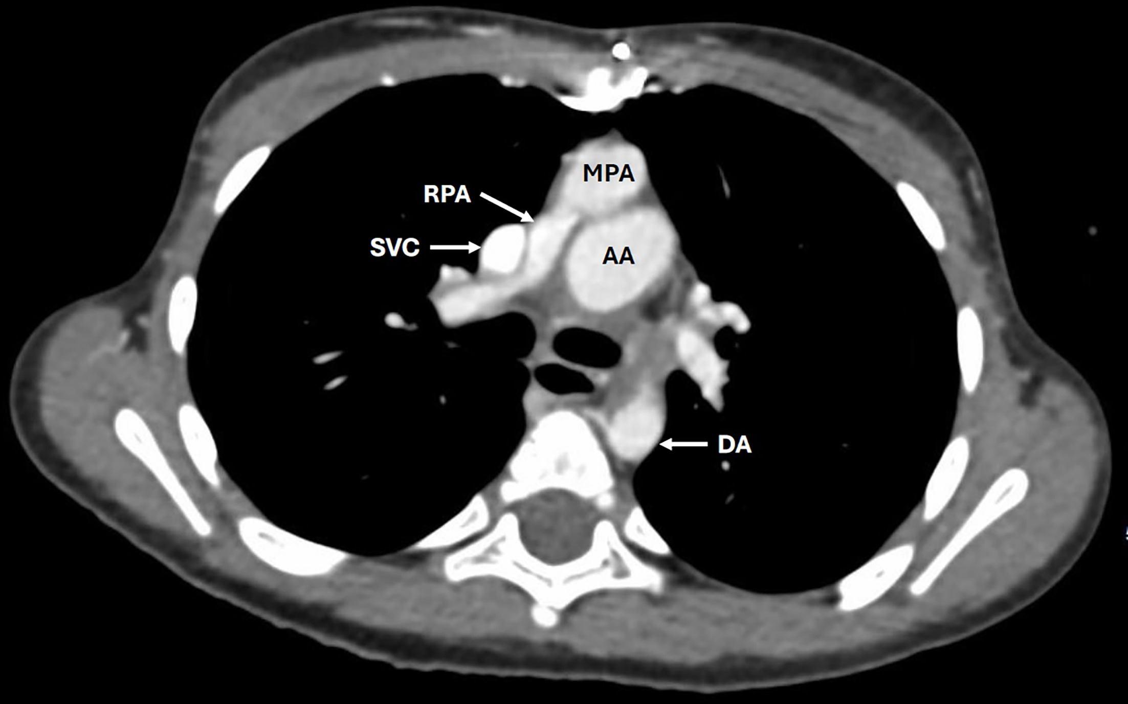Chest CTA with contrast in an axial plane at the main pulmonary artery. The right pulmonary artery is anterior to the ascending aorta consistent with the arterial switch operation. AA, ascending aorta; DA, descending aorta; MPA, main pulmonary artery; RPA, right pulmonary artery; SVC, superior vena cava.