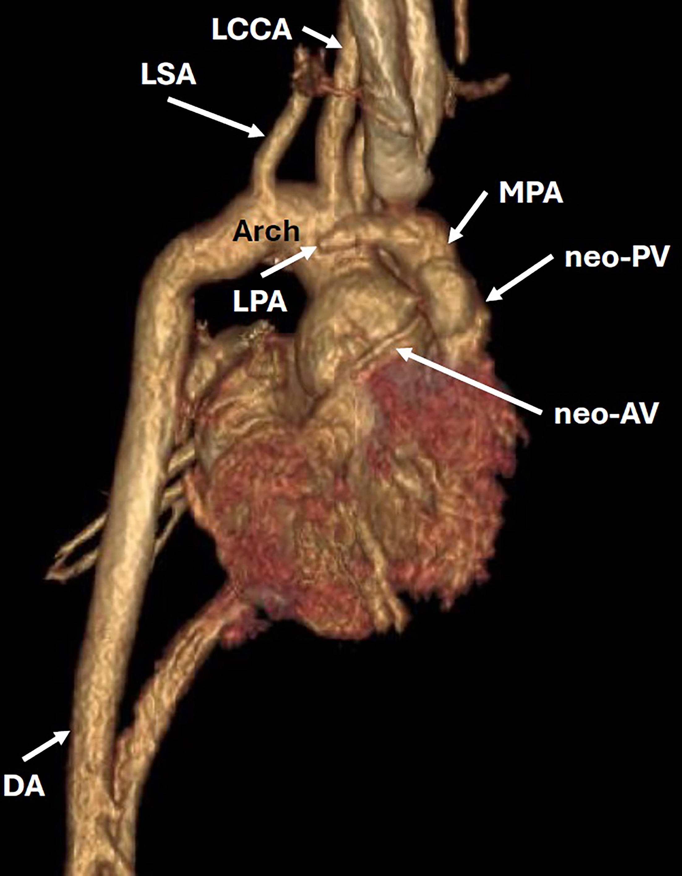3D chest CTA with contrast in a sagittal projection. The left pulmonary artery is anterior to the aorta and is stenotic. The aortic arch is normal in size. There is neo-aortic valve dilation. DA, descending aorta; LCCA, left common carotid artery; LPA, left pulmonary artery; LSA, left subclavian artery; MPA, main pulmonary artery; neo-AV, neo-aortic valve; neo-PV, neo-pulmonary valve.