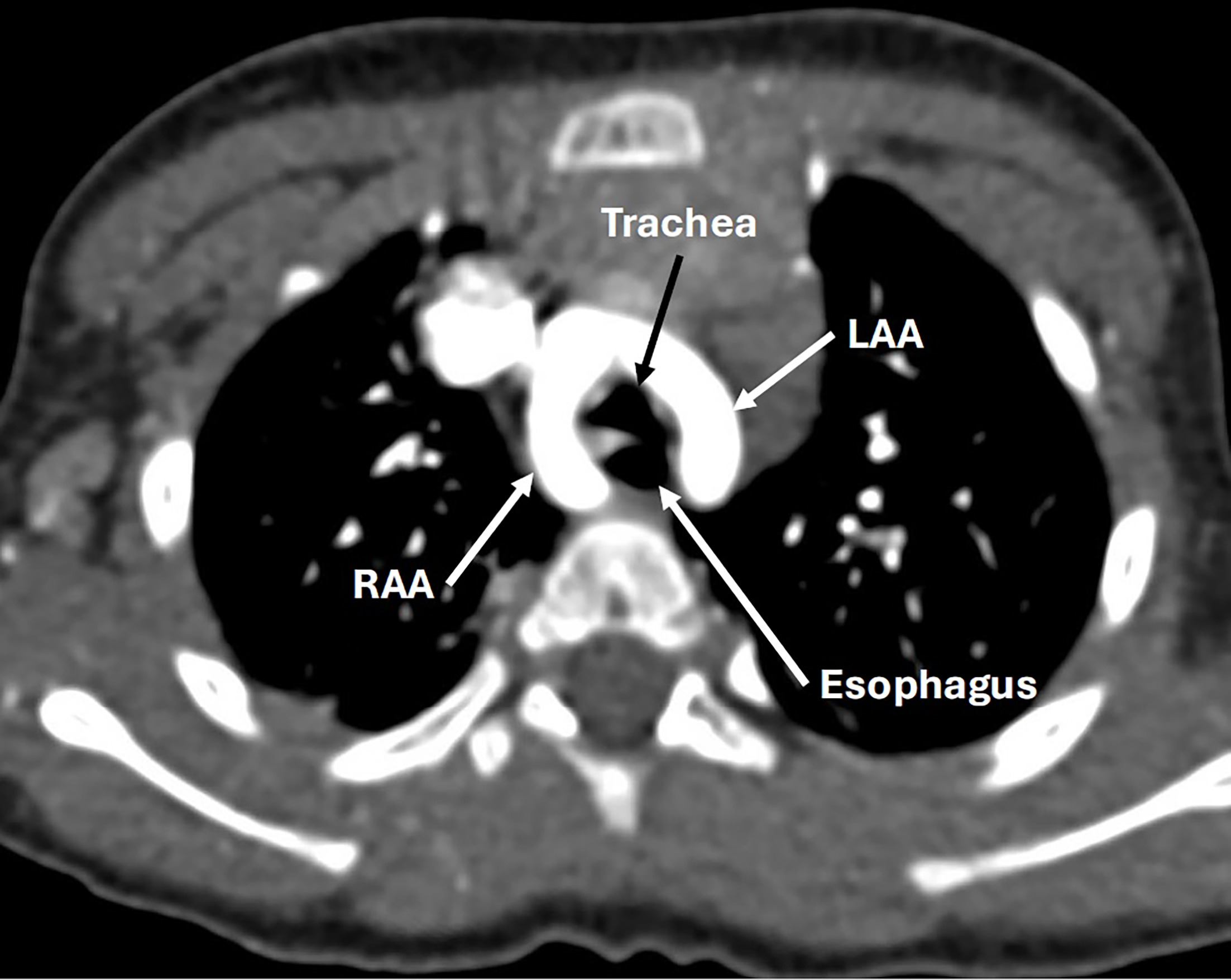 Chest CT with contrast in an axial plane. There is a double aortic arch with co-dominant arches encircling the trachea and esophagus. LAA, left aortic arch; RAA, right aortic arch.