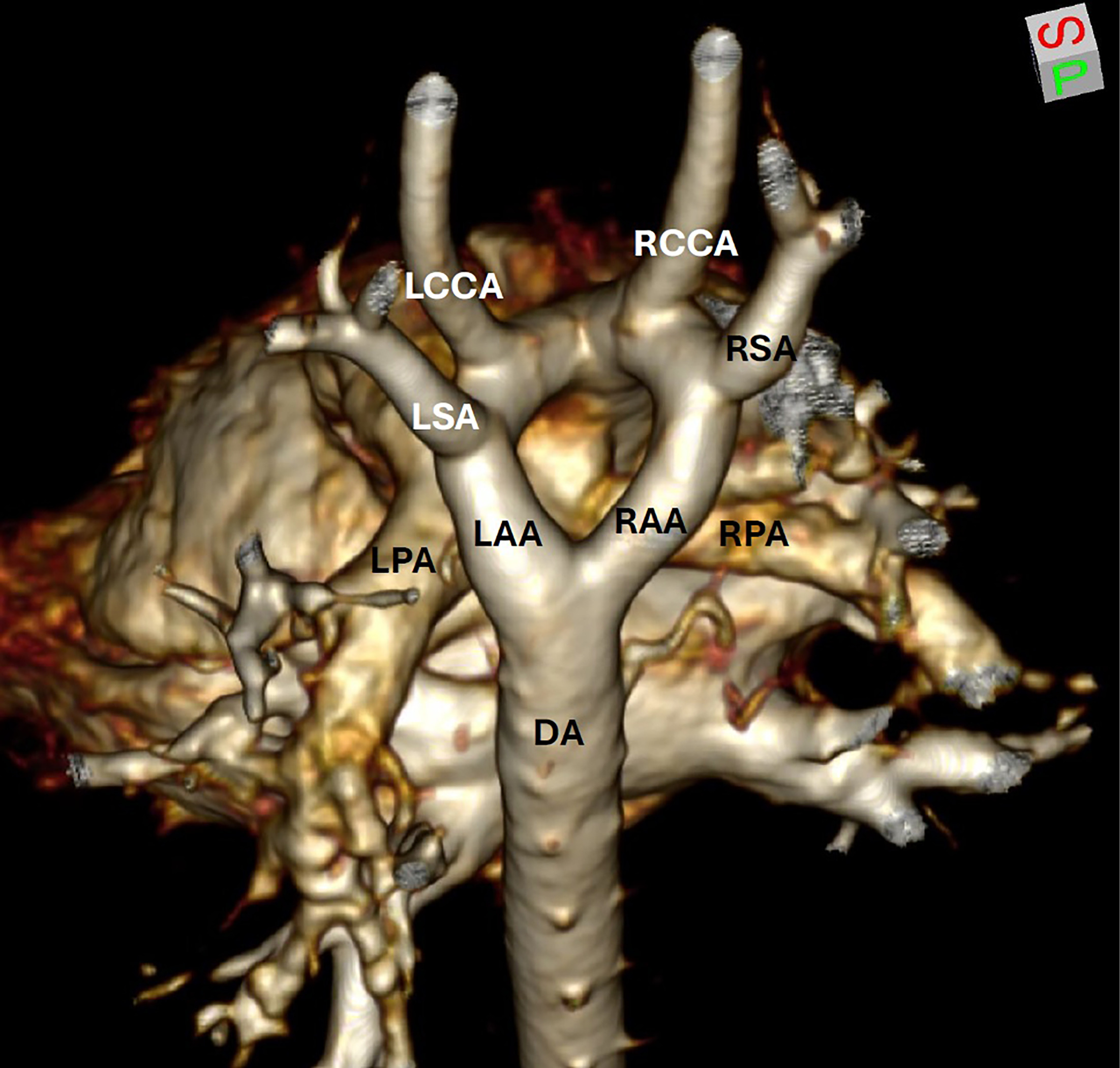 Chest CT with contrast 3D reconstruction off-axis coronal projection from posterior. There is a double aortic arch with co-dominant arches. The right subclavian and right common carotid arteries arise from the right aortic arch. The left subclavian and left common carotid arteries arise from the left aortic arch. DA, descending aorta; LAA, left aortic arch; LCCA, left common carotid artery; LPA, left pulmonary artery; LSA, left subclavian artery; RAA, right aortic arch; RCCA, right common carotid artery; RPA, right pulmonary artery; RSA, right subclavian artery.