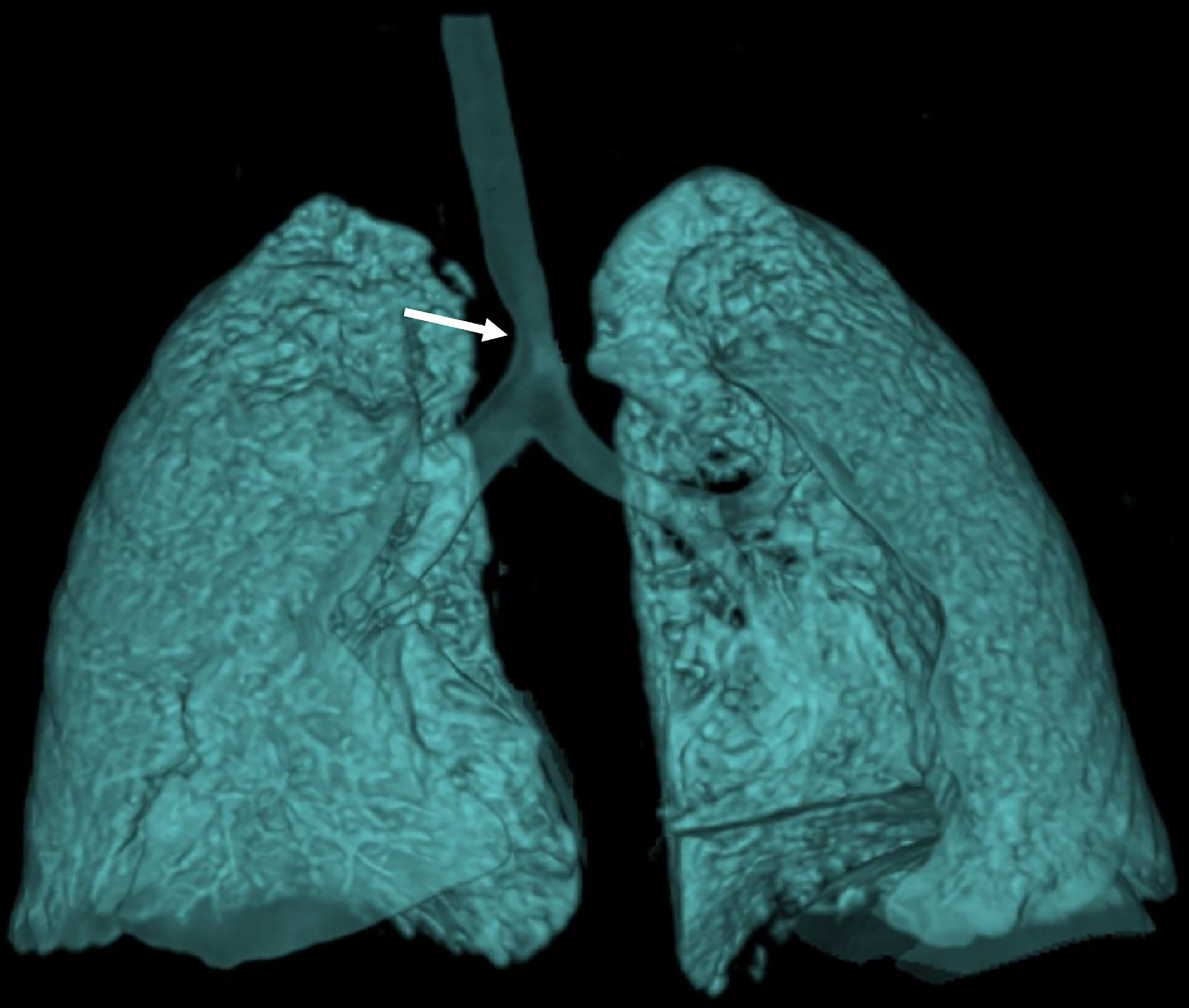 Chest CT with contrast dynamic airway assessment coronal projection. There is distal tracheal narrowing (arrow) at the left of the double aortic arch.