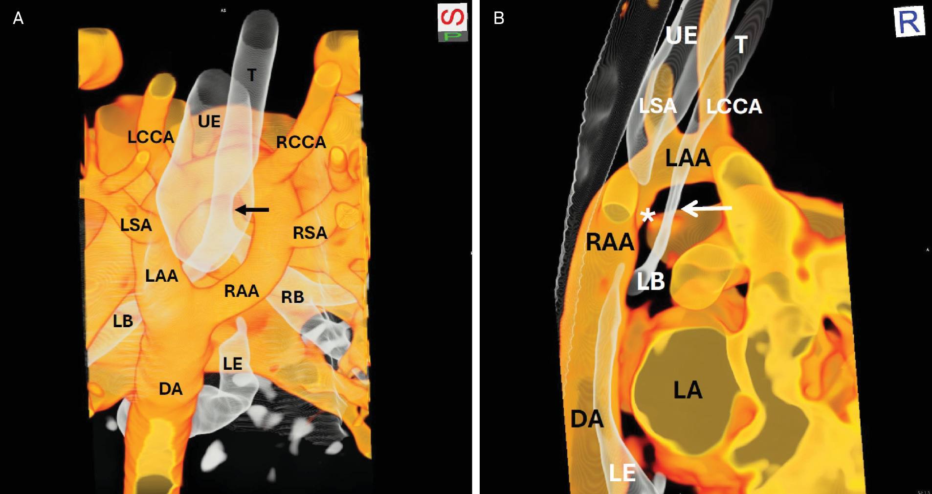 (A) Chest CT with contrast hollow vessel 3D reconstruction off-axis coronal projection from posterior. There is a double aortic arch with co-dominant arches with compression of the distal trachea (arrow) and mid esophagus. DA, descending aorta; LAA, left aortic arch; LB, left bronchus; LCCA, left common carotid artery; LE, lower esophagus; LSA, left subclavian artery; RAA, right aortic arch; RB, right bronchus; RCCA, right common carotid artery; RSA, right subclavian artery; T, trachea; UE, upper esophagus. (B). Chest CT with contrast hollow vessel 3D reconstruction sagittal projection. There is compression of the mid esophagus (asterisk) and narrowing of the distal trachea (arrow) at the level of the double aortic arch. DA, descending aorta; LAA, left aortic arch; LB, left bronchus; LCCA, left common carotid artery; LE, lower esophagus; LSA, left subclavian artery; RAA, right aortic arch; T, trachea; UE, upper esophagus.