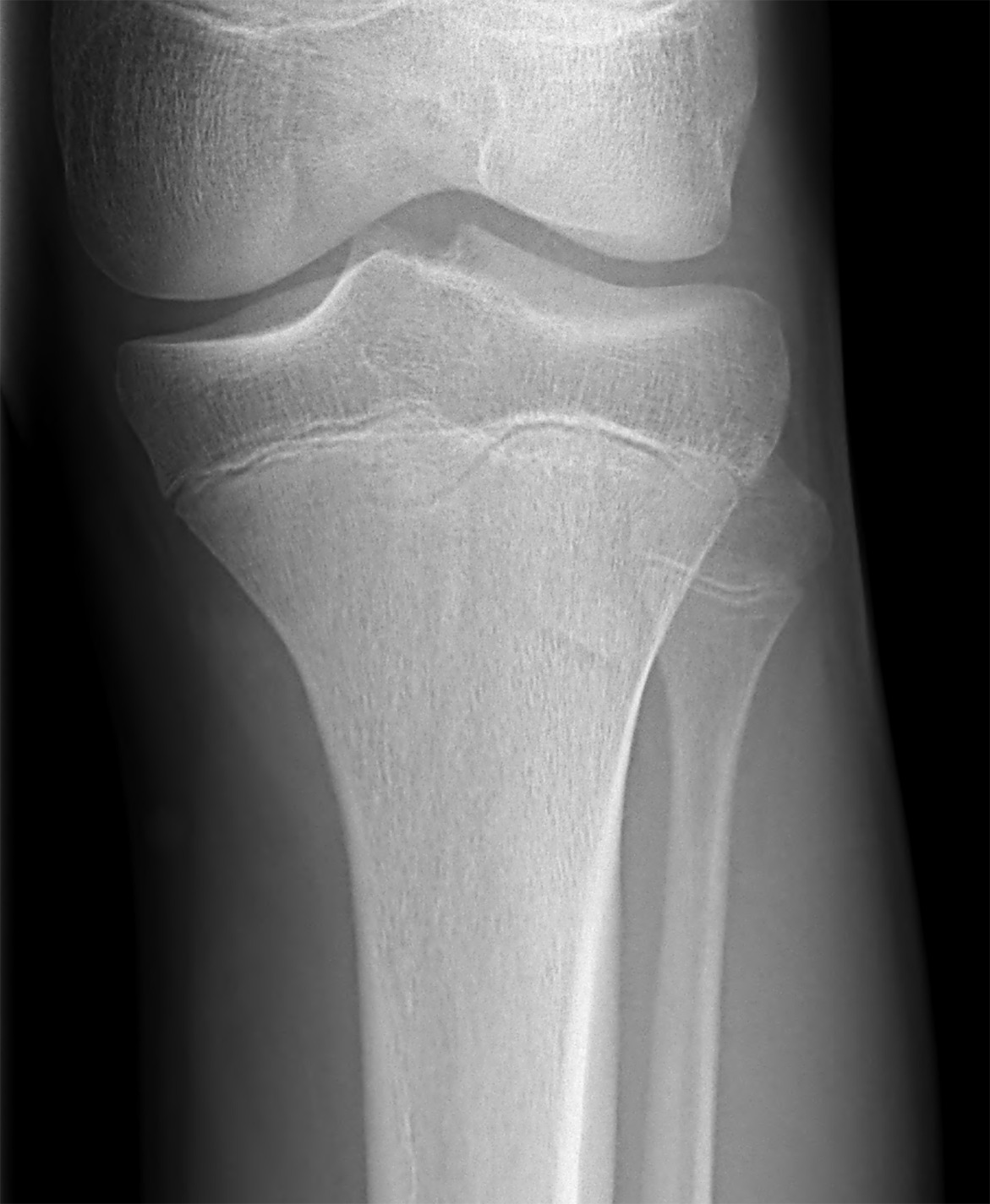Anteroposterior radiograph of the proximal left tibia is normal.