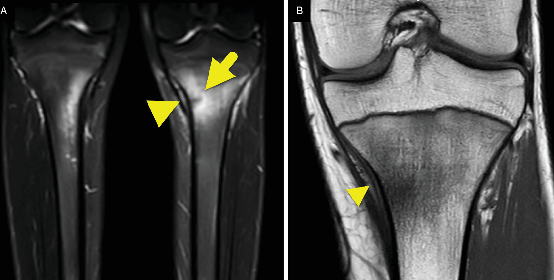 MRI performed 5 days after the initial radiograph. (A) Coronal STIR sequence of the lower legs showing edema signal within the medial aspect of each proximal tibial metaphysis. (A) T2 hypointense fracture line (arrow) is present on the left. The periosteum (arrowhead) is uplifted at the site of stress fracture. (B) Coronal T1-weighted image of the proximal left tibia showing amorphous low signal in the proximal tibia metaphysis. The periosteum (arrowhead) is uplifted at this location.