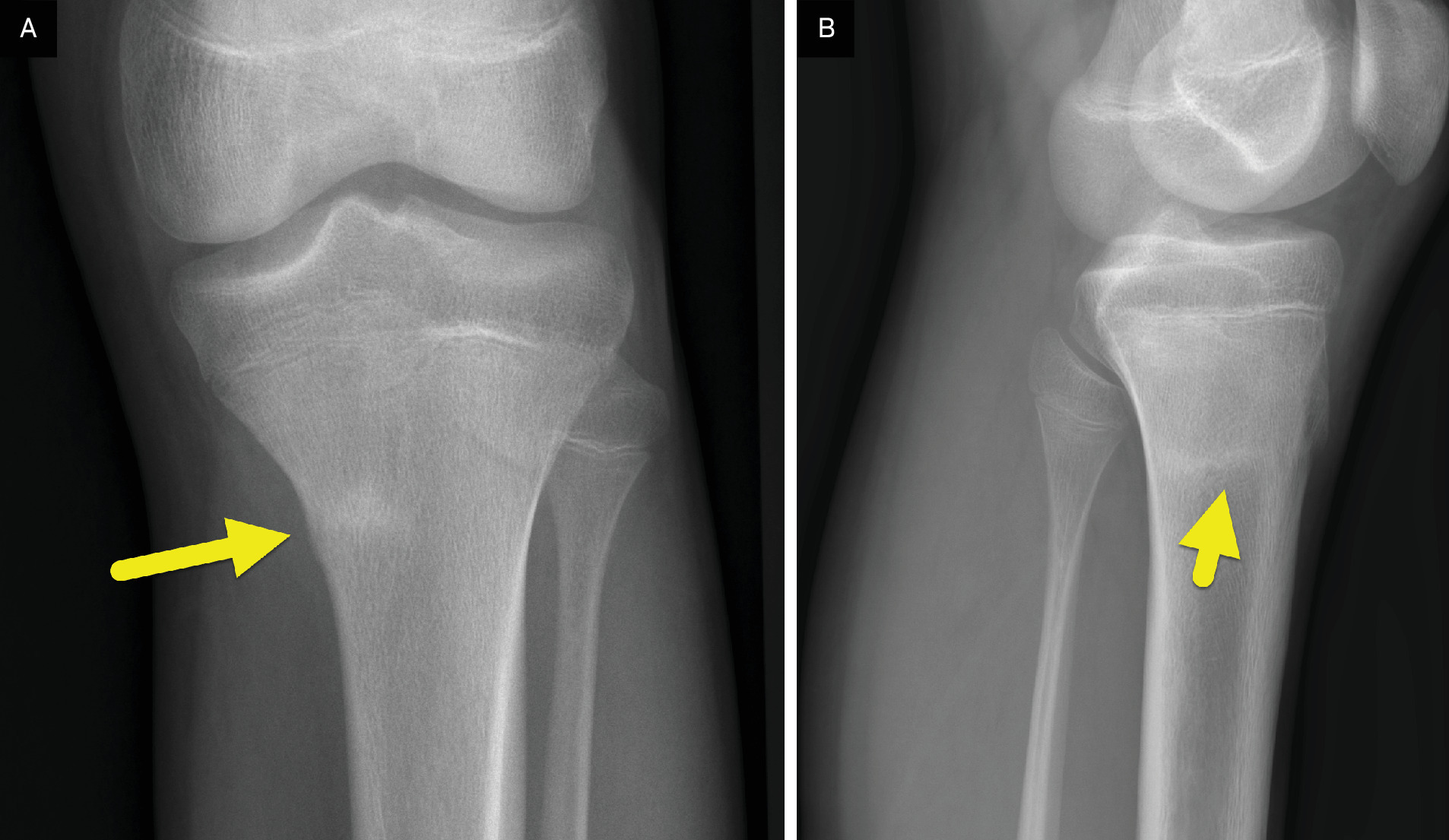 (A) Anteroposterior and (B) lateral radiographs performed 1 month later showing healing changes at the site of stress fracture with a linear band of sclerosis (arrow) and a healing periosteal reaction.