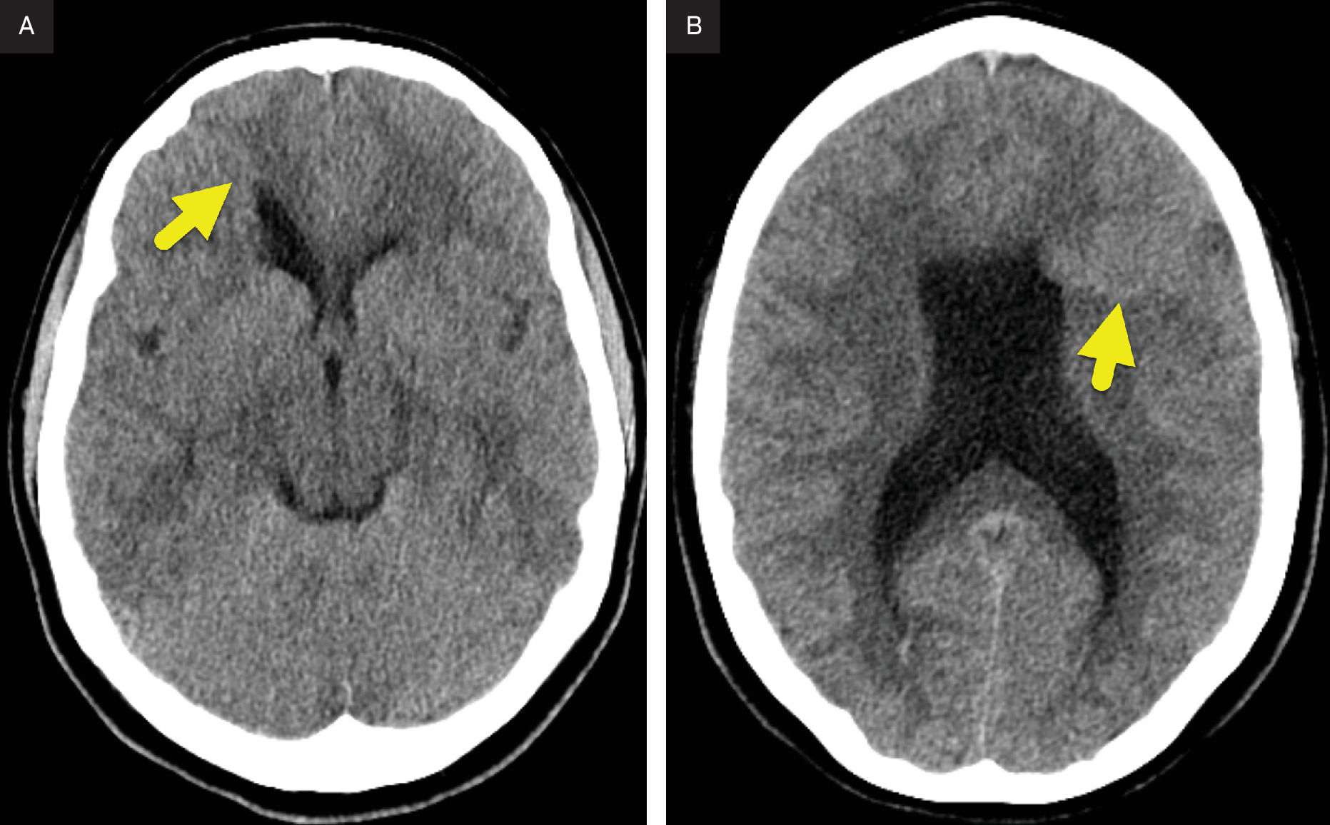 Axial CT images at the level of (A) the frontal horns of the lateral ventricles and (B) the body of the lateral ventricles showing the absence of the septum pellucidum and bilateral closed-lip schizencephaly (arrow) with gray matter lining each cleft.