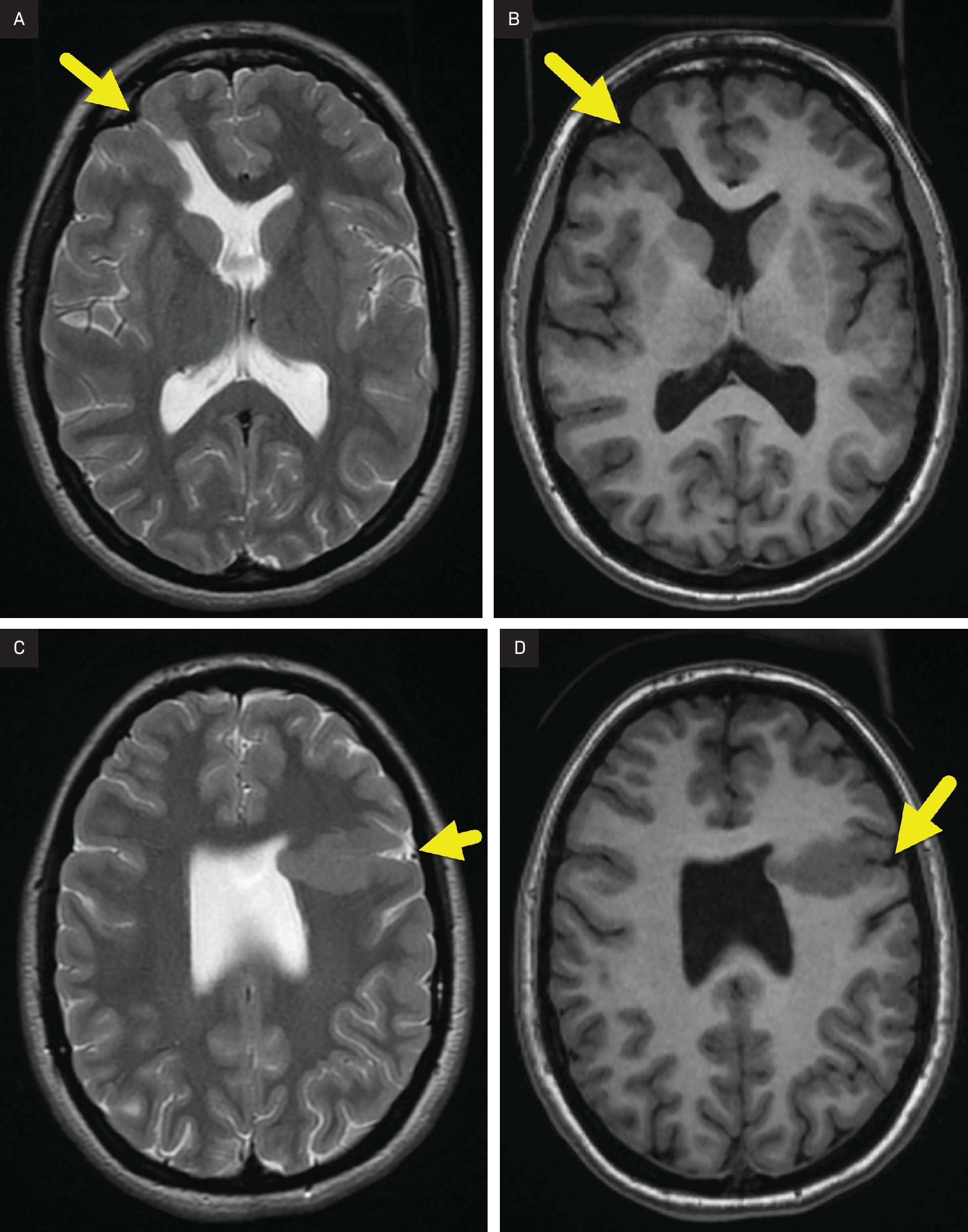 (A) Axial T2-weighted and (B) T1 FLAIR images at the level of the frontal horns of the lateral ventricles and (C) axial T2-weighted and (D) T1 FLAIR images at the level of the mid body of the lateral ventricles showing the absence of the septum pellucidum and bilateral closed-lip schizencephaly (arrow) with gray matter lining each cleft. Polymicrogyria is present at each cleft.
