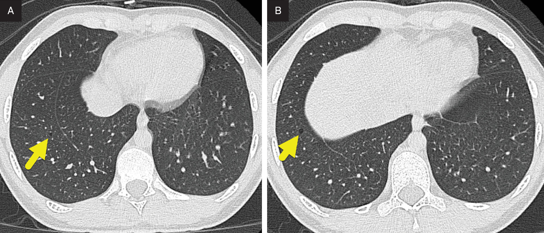 (A, B) Sequential images from chest CT showing several small cysts (arrows) with imperceptible walls.