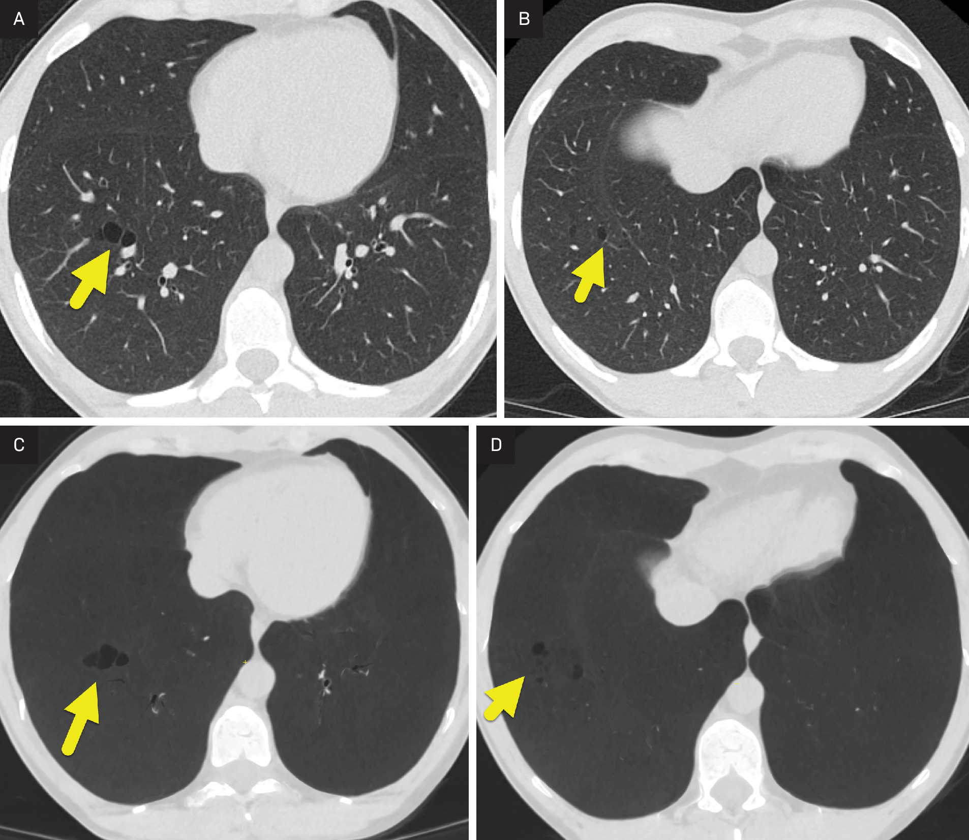 (A, B) Sequential images from chest CT performed 12 years later showing that the small cysts (arrow) have increased in size and number. (C, D) Minimum intensity projection images at the same levels highlighting the extent of the small cysts.