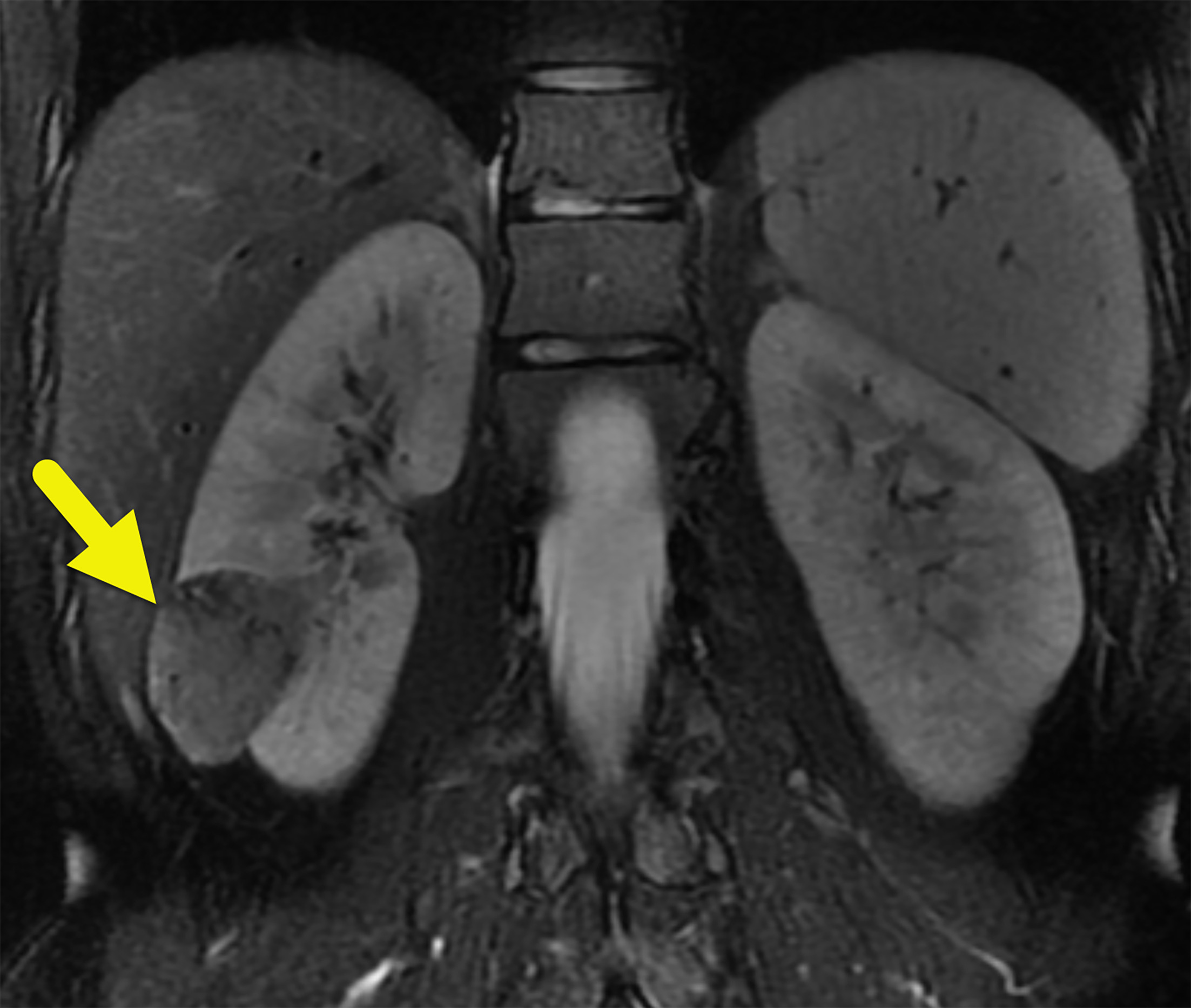 Coronal T2-weighted MRI showing a dominant lipid-poor angiomyolipoma in the lower pole of the right kidney. There are many tiny angiomyolipomata throughout both kidneys, giving the cortex a striated appearance.