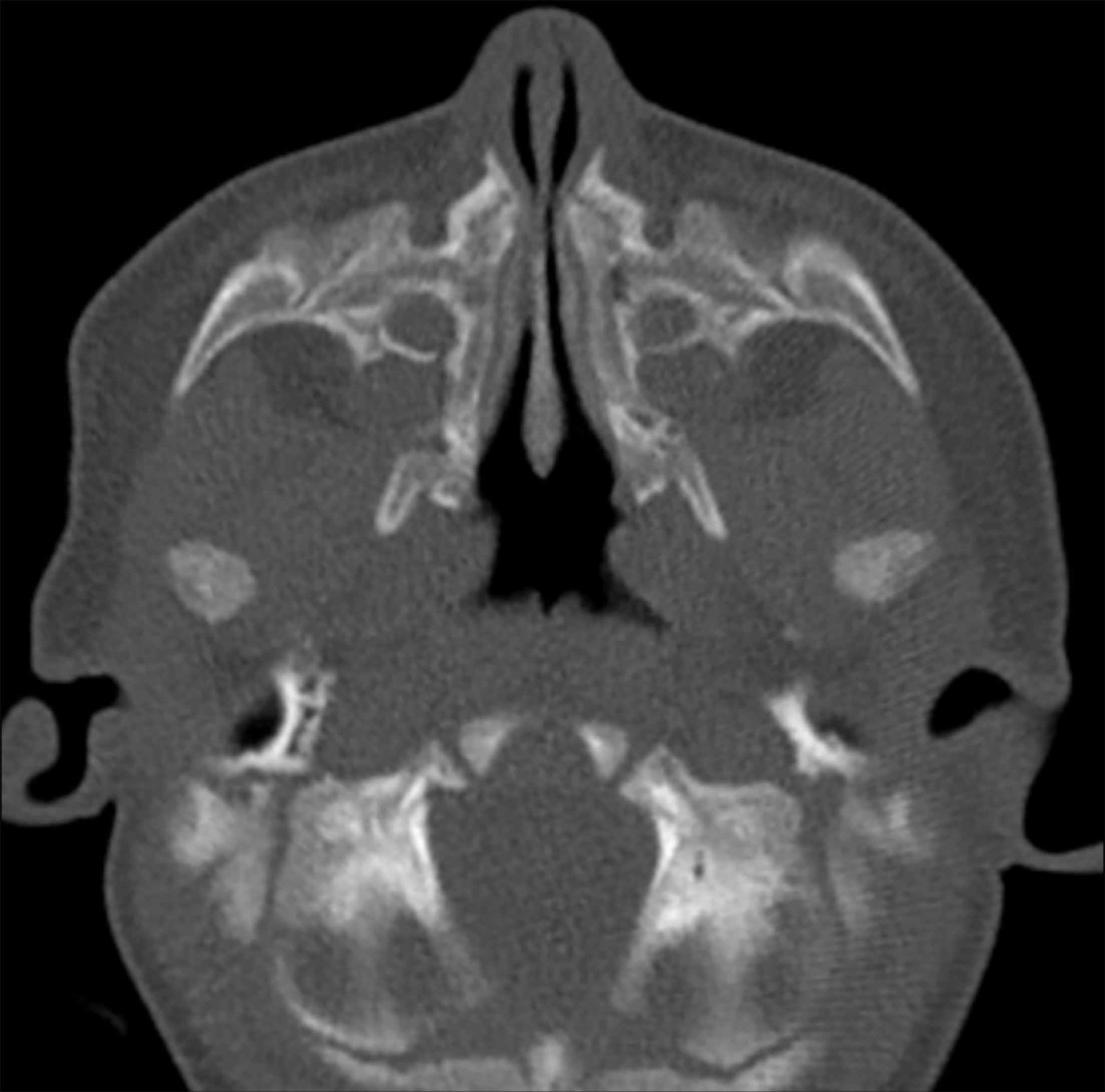 Axial CT at the level of the nasal cavity showing severe narrowing (arrow) of both nasal pyriform apertures measuring <4.5 mm in width with a high degree of obstruction. There were paired central incisors and a normal pituitary fossa and gland (not shown).