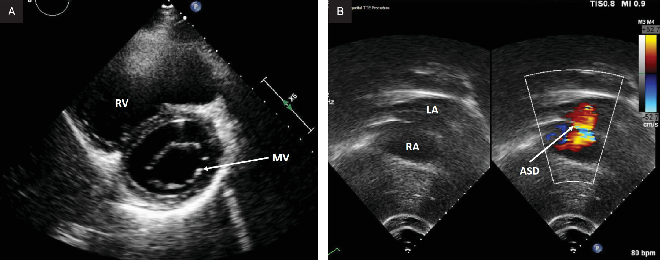 (A) Parasternal short-axis transthoracic echocardiogram at end-diastole showing moderate right ventricular chamber dilation. MV, mitral valve; RV, right ventricle. (B) Subcostal coronal color compare at end-diastole showing a large secundum ASD. ASD, atrial septal defect; LA, left atrium; RA, right atrium.