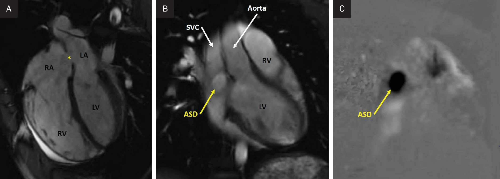 (A) A 4-chamber CMR cine steady state free precession (SSFP) at end-diastole showing a large secundum ASD (yellow asterisk), moderately dilated right atrium and right ventricle, and a small anterior pericardial effusion. The right ventricular end-diastolic volume was 120 mL/m2 (normal 60-100 mL/m2). LA, left atrium; LV, left ventricle; RA, right atrium; RV, right ventricle. (B) ASD en face view (off-axis coronal view) CMR cine SSFP at end-diastole showing a large secundum ASD (yellow arrow). ASD, atrial septal defect; LV, left ventricle; RV, right ventricle; SVC, superior vena cava. (C). ASD en face view CMR phase contrast through plane at end-diastole showing the shunting through the ASD (yellow arrow). The flow through the ASD was 4.59 L/minute. The flow across the aortic valve was 3 L/minute, and the pulmonary valve was 7.60 L/minute. The calculated Qp:Qs was 2.5:1. ASD, atrial septal defect.