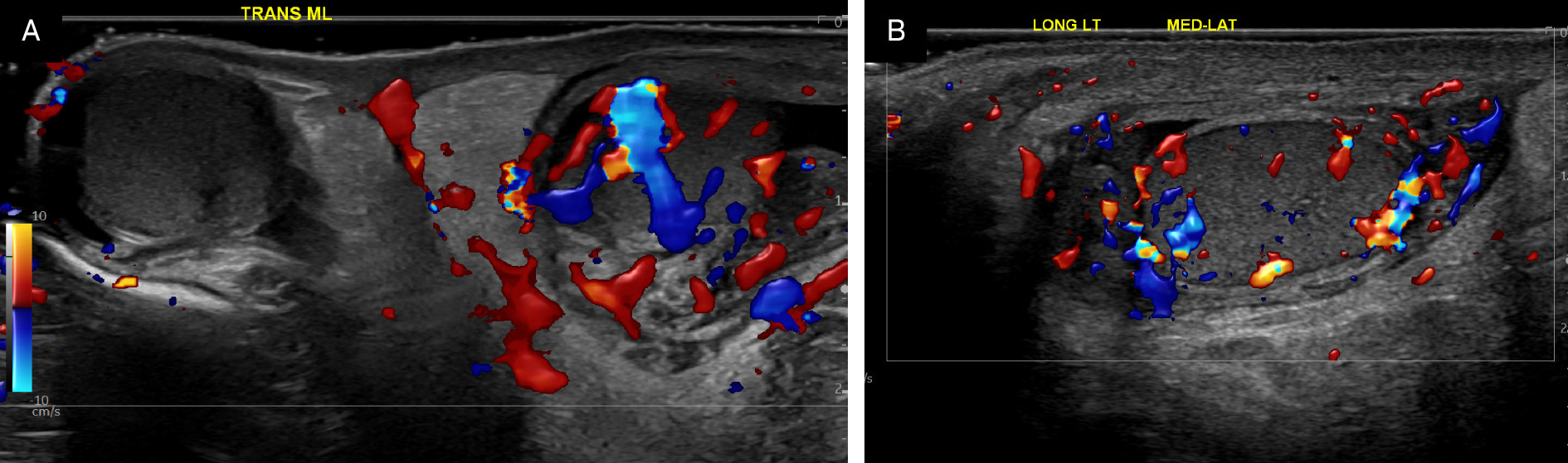 (A) Transverse color Doppler US image of the testes showing relative hyperemia of the left testis and mild left scrotal wall thickening. (B) Longitudinal color Doppler US image of the left testis confirms increased vascularity and mild scrotal wall thickening.