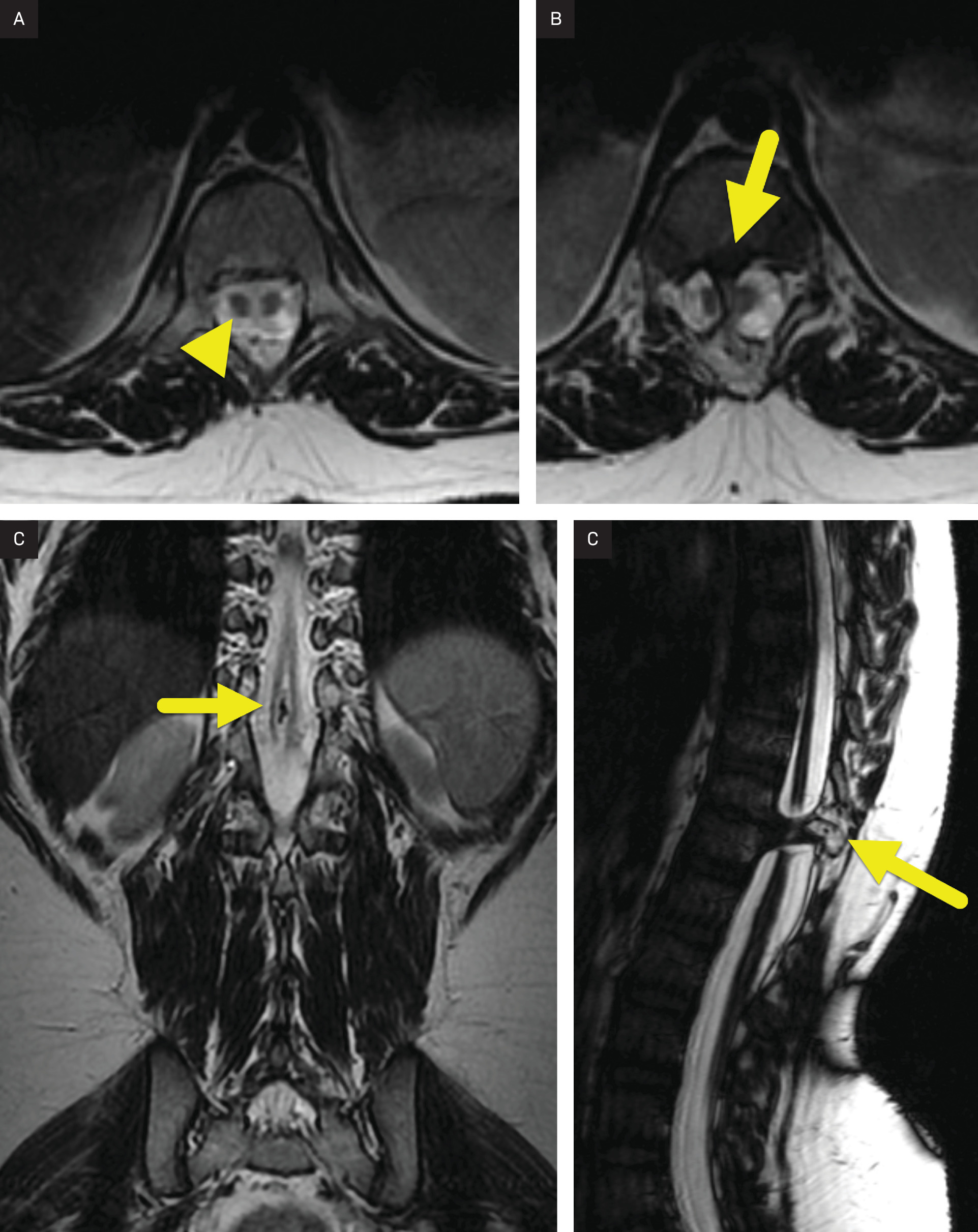 (A, B) Sequential axial T2-weighted images showing a split cord malformation (arrowhead) beginning just above the level of a bony bar (arrow). (C) Coronal T2-weghted image showing the split cord malformation caused by the bony bar (arrow). (D) Sagittal FIESTA image highlighting the extent of the bony bar (arrow).