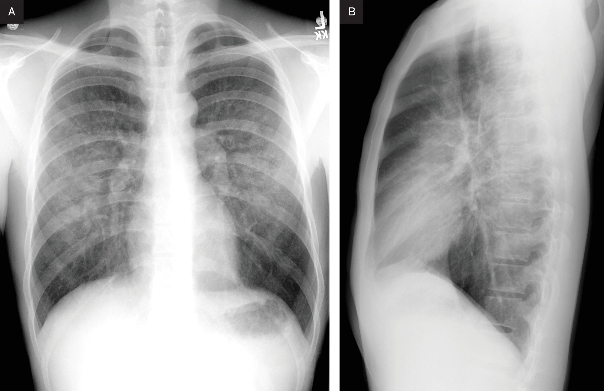 (A) Posteroanterior and (B) lateral chest radiographs showing bilateral central ground-glass opacities.
