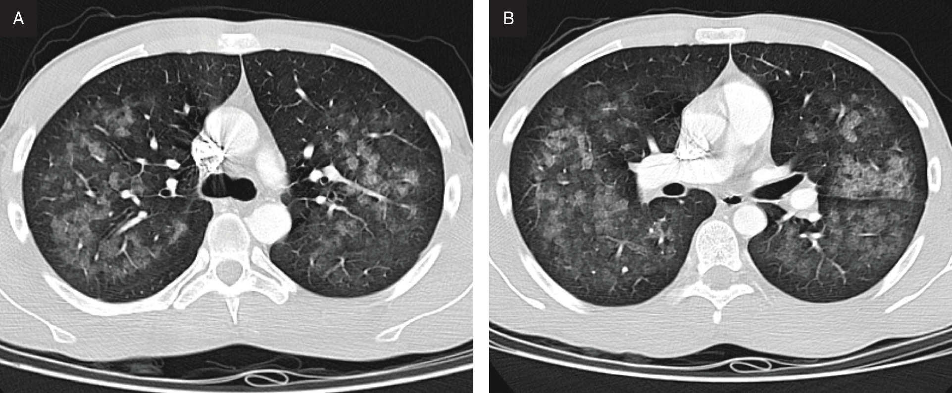 Axial chest CT images at the level of (A) the carina and (B) the main pulmonary artery demonstrating central ground-glass opacities with relative subpleural and lobular sparing.