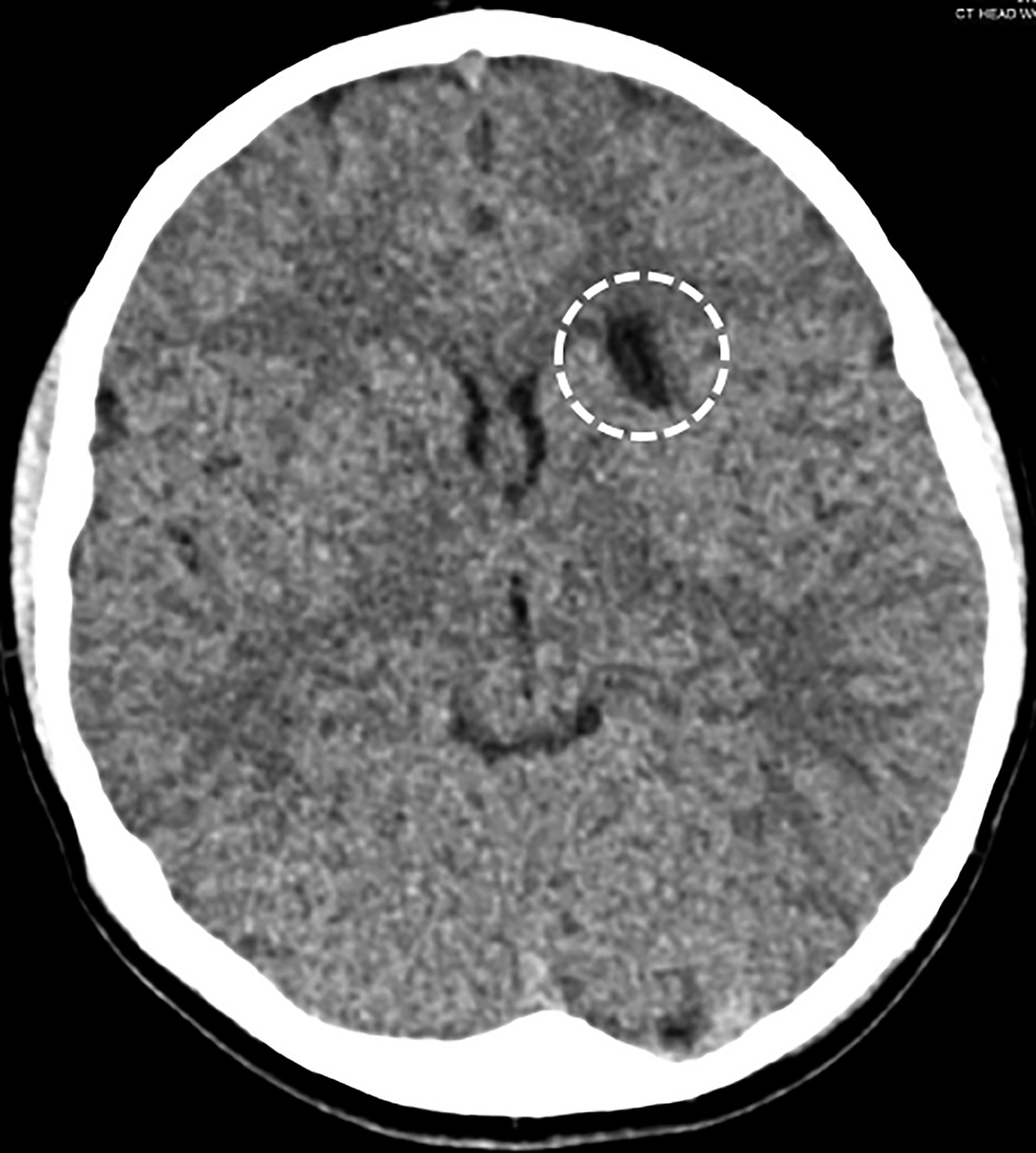 A nonenhanced axial CT image demonstrating a thin-walled intra-axial cystic structure (within the circle) just lateral to the left caudate nucleus.