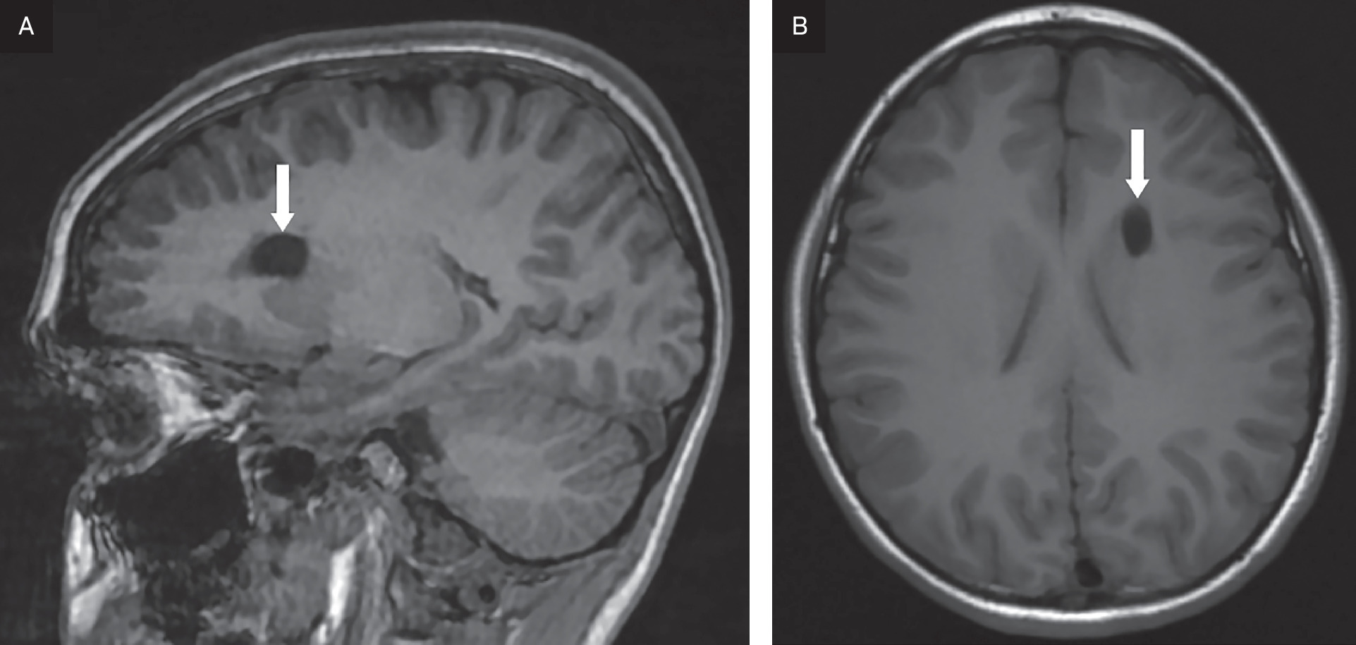 (A) A sagittal MR T1 BRAVO image demonstrateing low signal within the intra-axial cyst in the frontal lobe (arrow). (B) Noncontrast enhanced T1 FLAIR axial MRI locates this lesion just lateral to the left caudate nucleus (arrow).