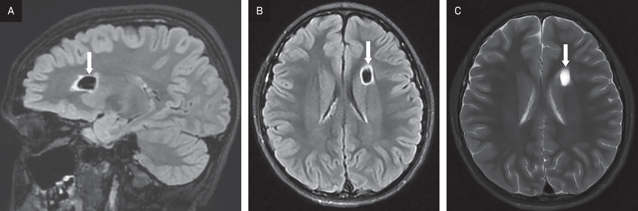 On noncontrast enhanced (A) sagittal and (B) axial T2 FLAIR MRI, the lesion contents are fully suppressed, like CSF, with a border of high-signal (arrow). (C) Noncontrast enhanced T2 PROPELLER fat saturation axial MRI demonstrating normal CSF-like T2 hyperintensity of the cyst contents.
