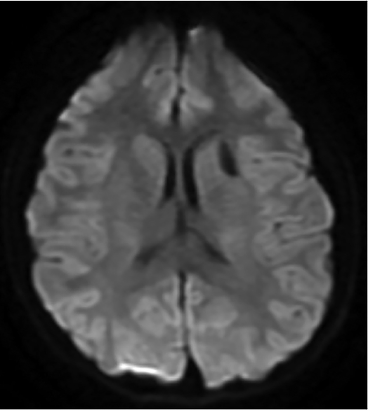 Noncontrast enhanced diffusion-weighted axial MRI showing nonrestriction of the cyst contents.