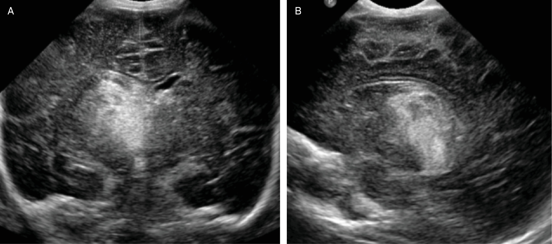 ( Head US Coronal (A) and Sagittal (B) performed at 22 hours of age showing intracranial hemorrhage involving the area of the right caudate nucleus and thalamus (arrows) and intra third ventricular blood (not shown). There was associated local mass effect and left to right midline shift.