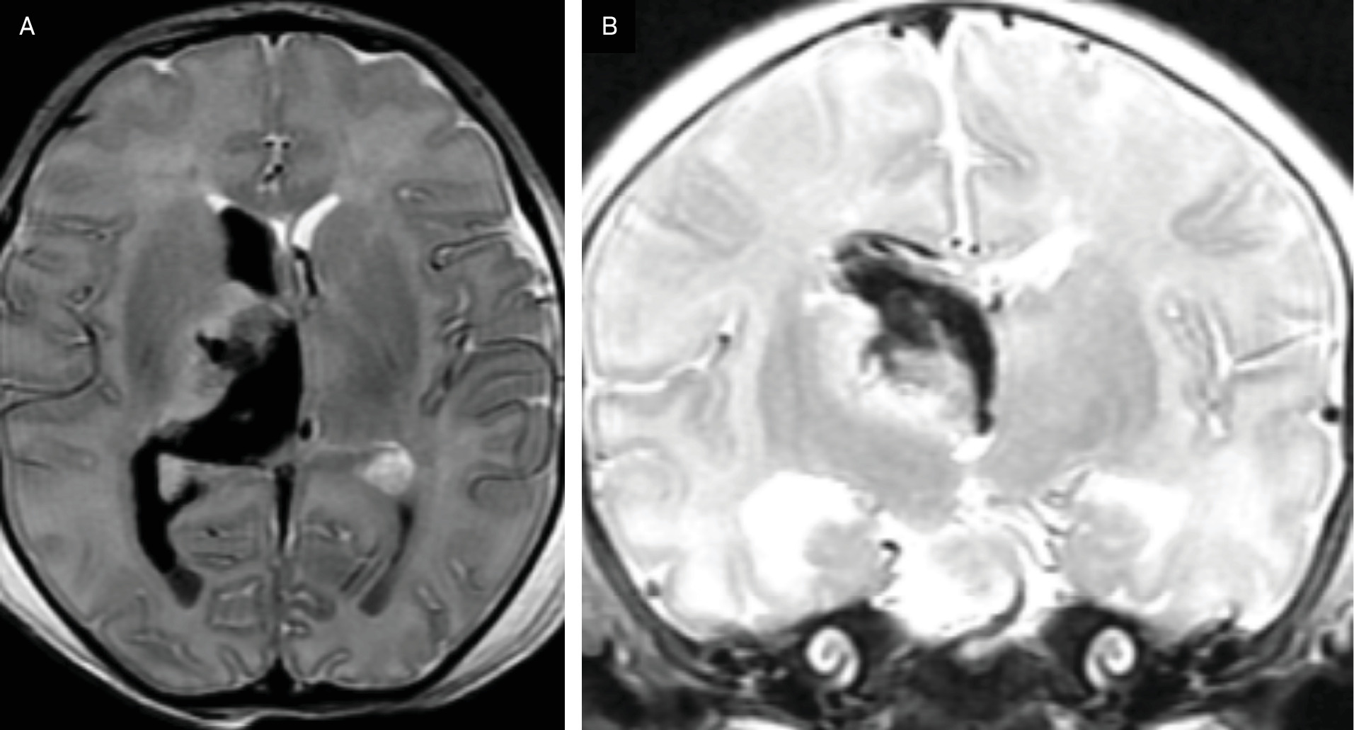 MRI performed on day 2 of life. (A, B) Axial and coronal T2-weighted images showing a large hemorrhagic mass bulging into the right frontal horn (arrowhead), bilateral intraventricular hemorrhage (arrow), involving the right lateral ventricle greater than left, and third ventricle, intracerebral hemorrhage involving the right basal ganglia and thalamus and diffusion restriction in the same region.