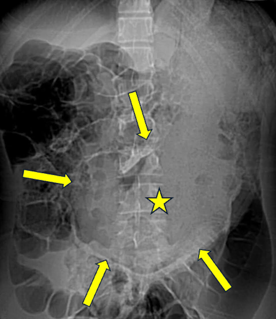 Scout image from abdominal CT scan showing distended stomach (arrows) with mixed density intragastric contents conforming to the gastric lumen shape (star).