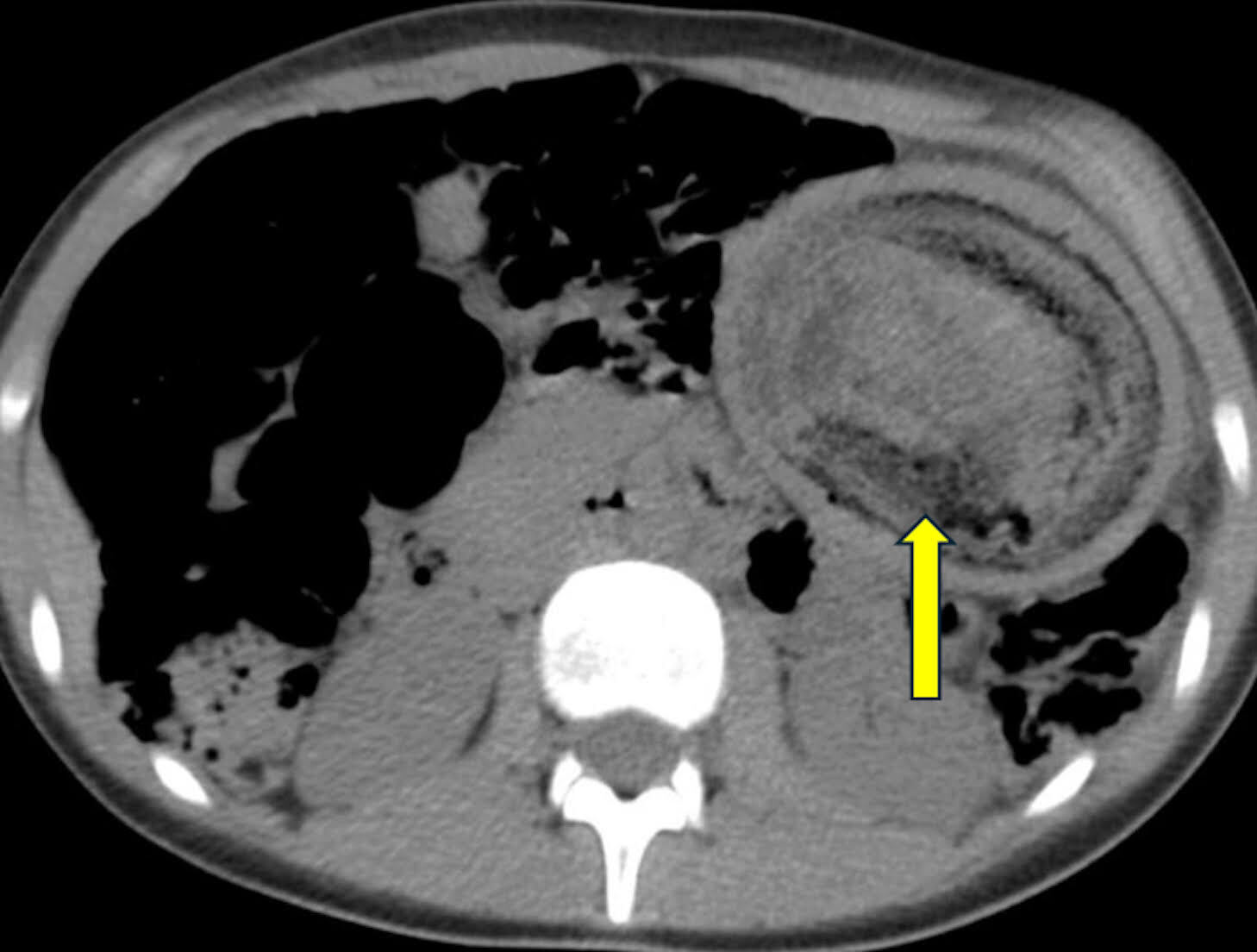 Axial nonenhanced abdominal CT showing an intragastric mass with mixed density and an inner rim of gas bubbles (speckled appearance) with the attenuation diagnostic of bezoar.