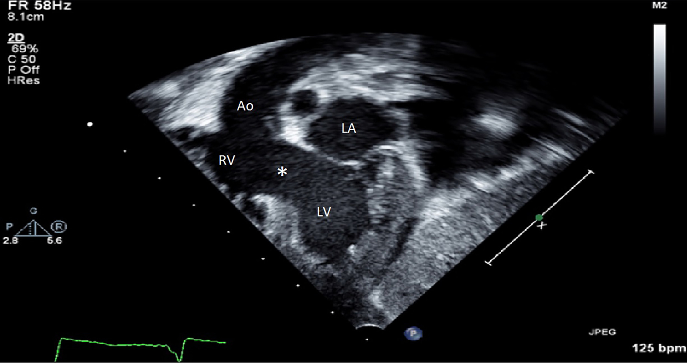 Postnatal transthoracic echocardiogram 2-D 4-chamber view in systole showing the relative size of ventricles and the large ventricular septal defect (*). The right ventricle gives rise to the aorta. Ao, aorta; LA, left atrium; LV, left ventricle; RV, right ventricle.