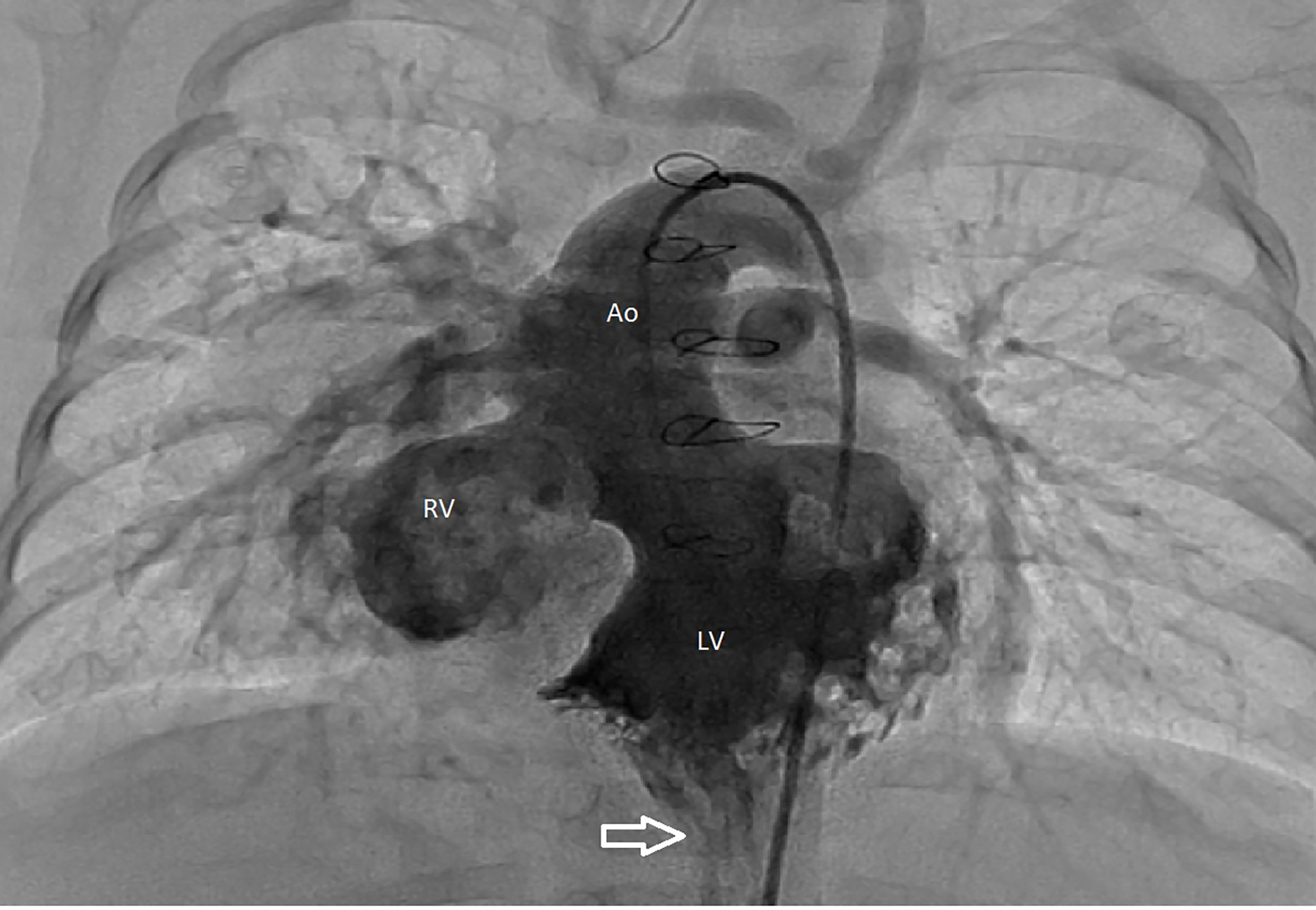 Cardiac catheterization angiogram: left ventricle (10 mL at 15 mL/second via power injection in straight anteroposterior projection). A catheter courses retrograde through the aortic arch into the right ventricle across a ventricular septal defect into the left ventricle. The contrast flows from the left ventricle through a large conoventricular (outlet) ventricular septal defect into the right ventricle and out the aorta. The apex of the left ventricle extends inferiorly coming to a sharp point below the sternum (arrow). The apex is also positioned very anteriorly in the chest wall. Ao, aorta; LV, left ventricle; RV, right ventricle.